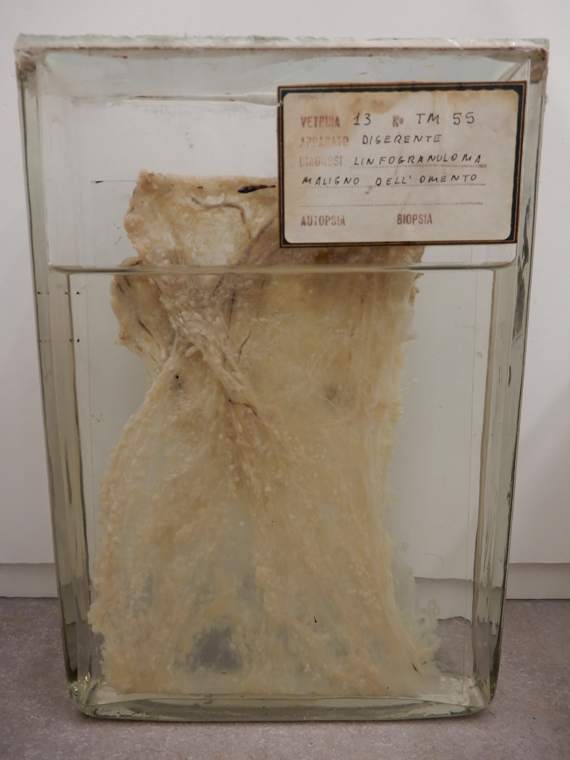 singolo reperto antropologico, preparato anatomico (morfologia alterata per patologia) (XIX-XX)