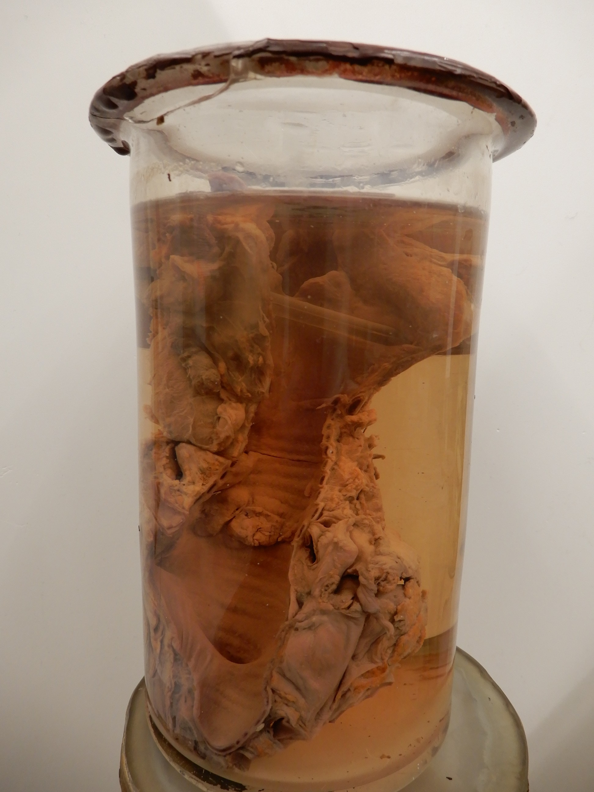 singolo reperto antropologico, preparato anatomico (morfologia alterata per patologia) (XIX-XX)