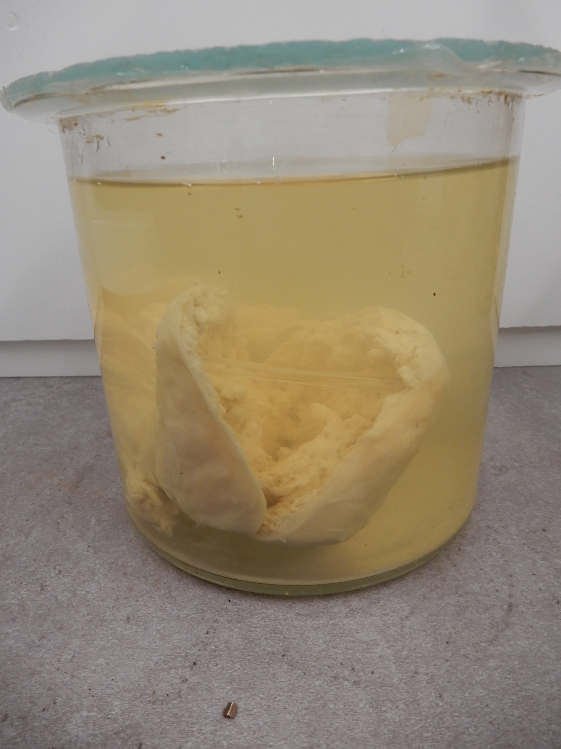 singolo reperto antropologico, preparato anatomico (morfologia alterata per patologia) (XIX-XX)