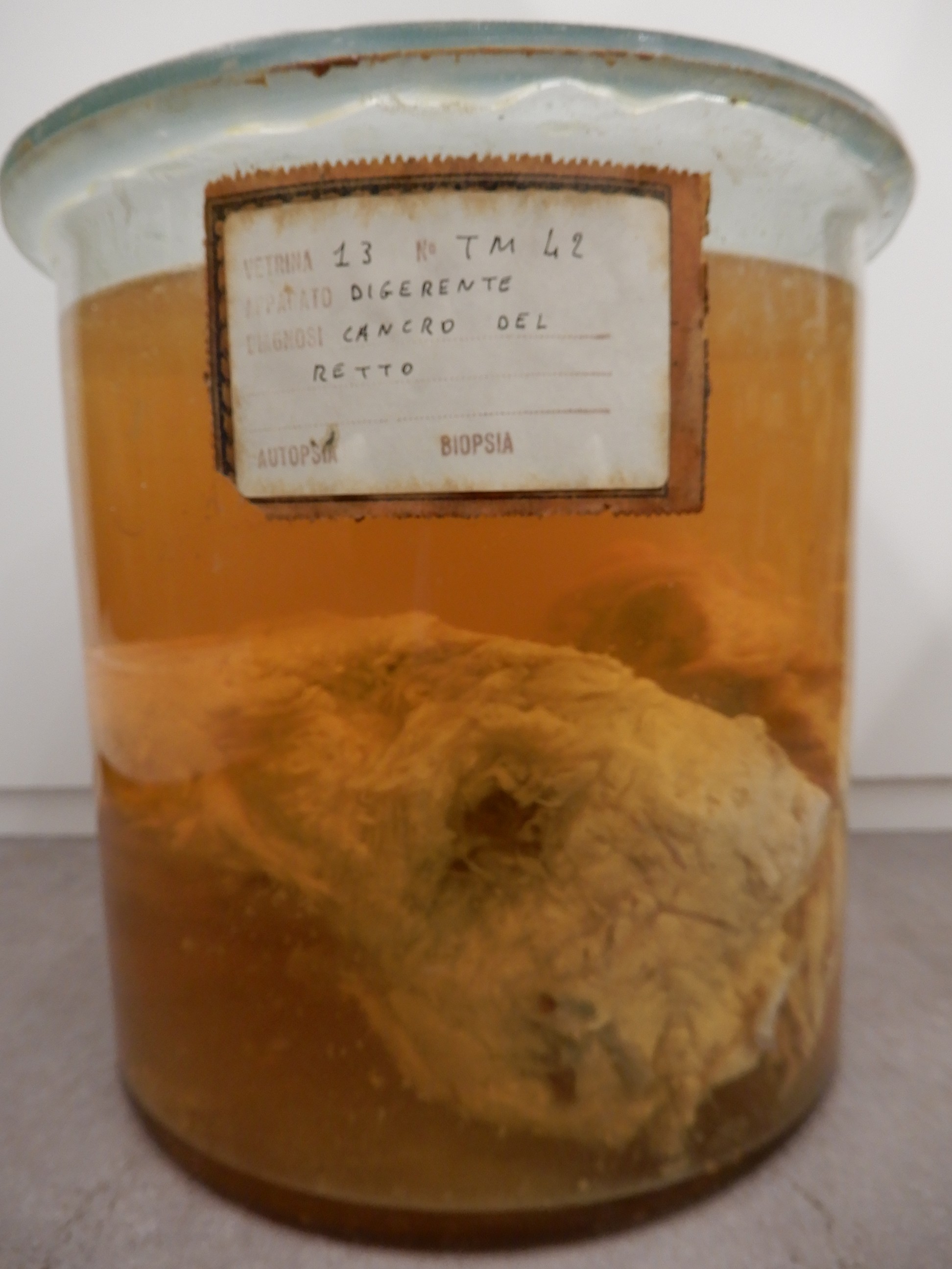 singolo reperto antropologico, preparato anatomico (morfologia alterata per patologia) (XIX-XX)