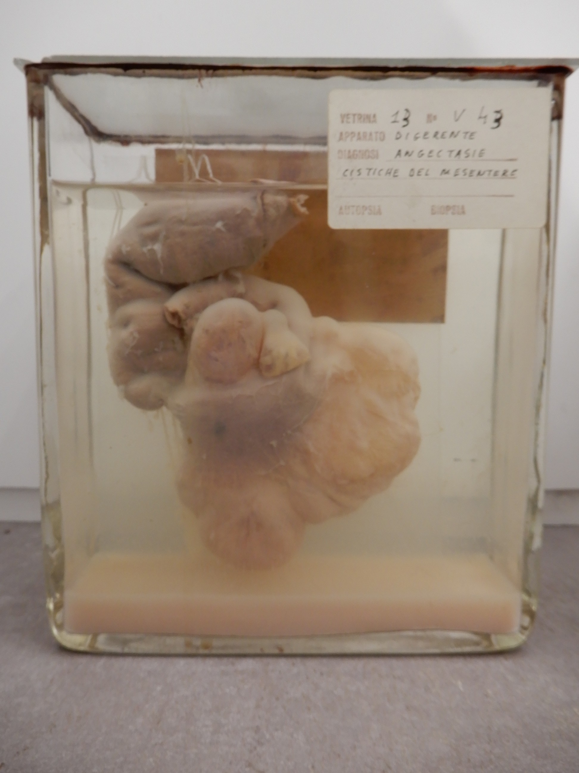 singolo reperto antropologico, preparato anatomico (morfologia alterata per patologia) (XIX-XX)