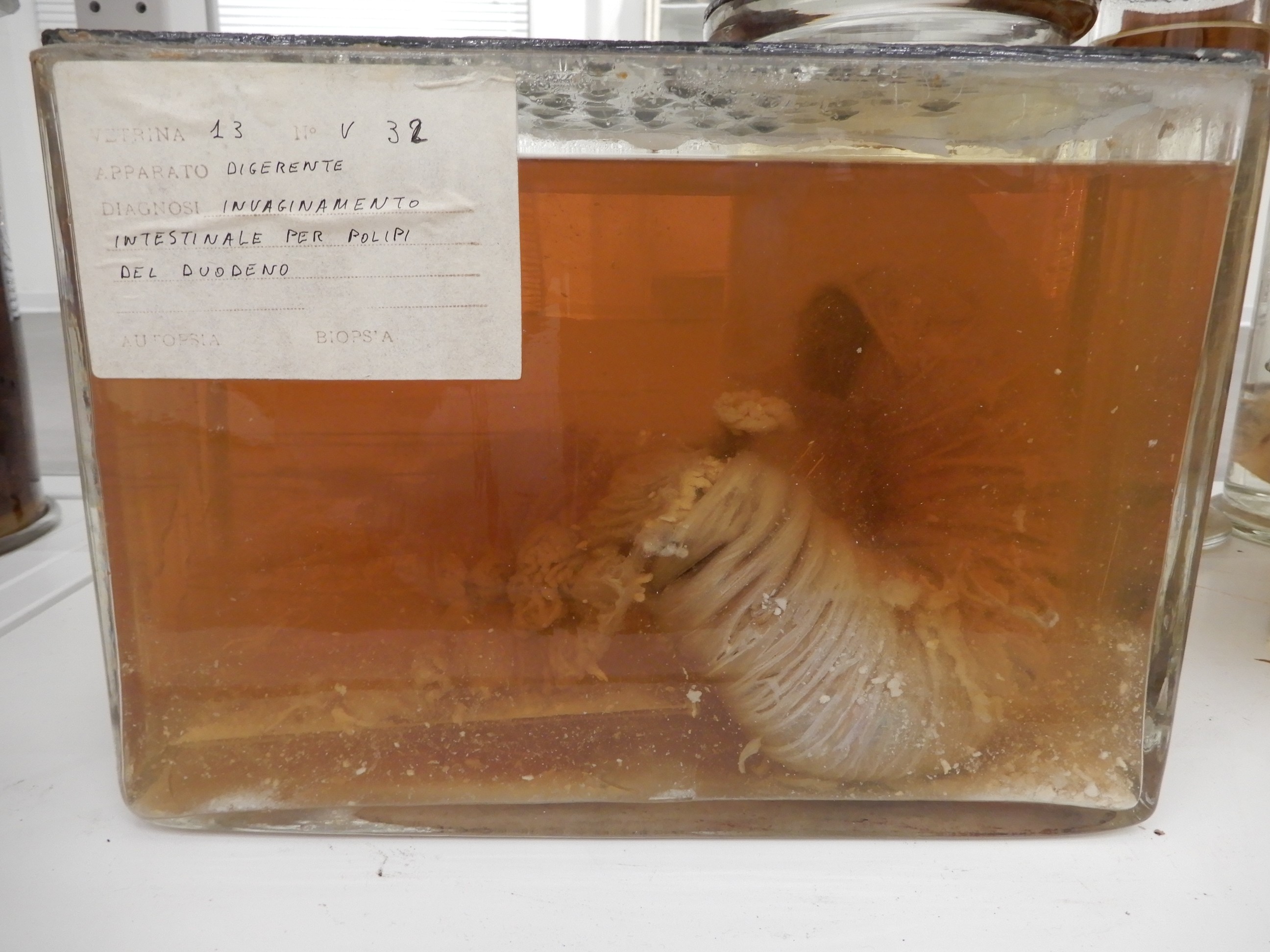 singolo reperto antropologico, preparato anatomico (morfologia alterata per patologia) (XIX-XX)