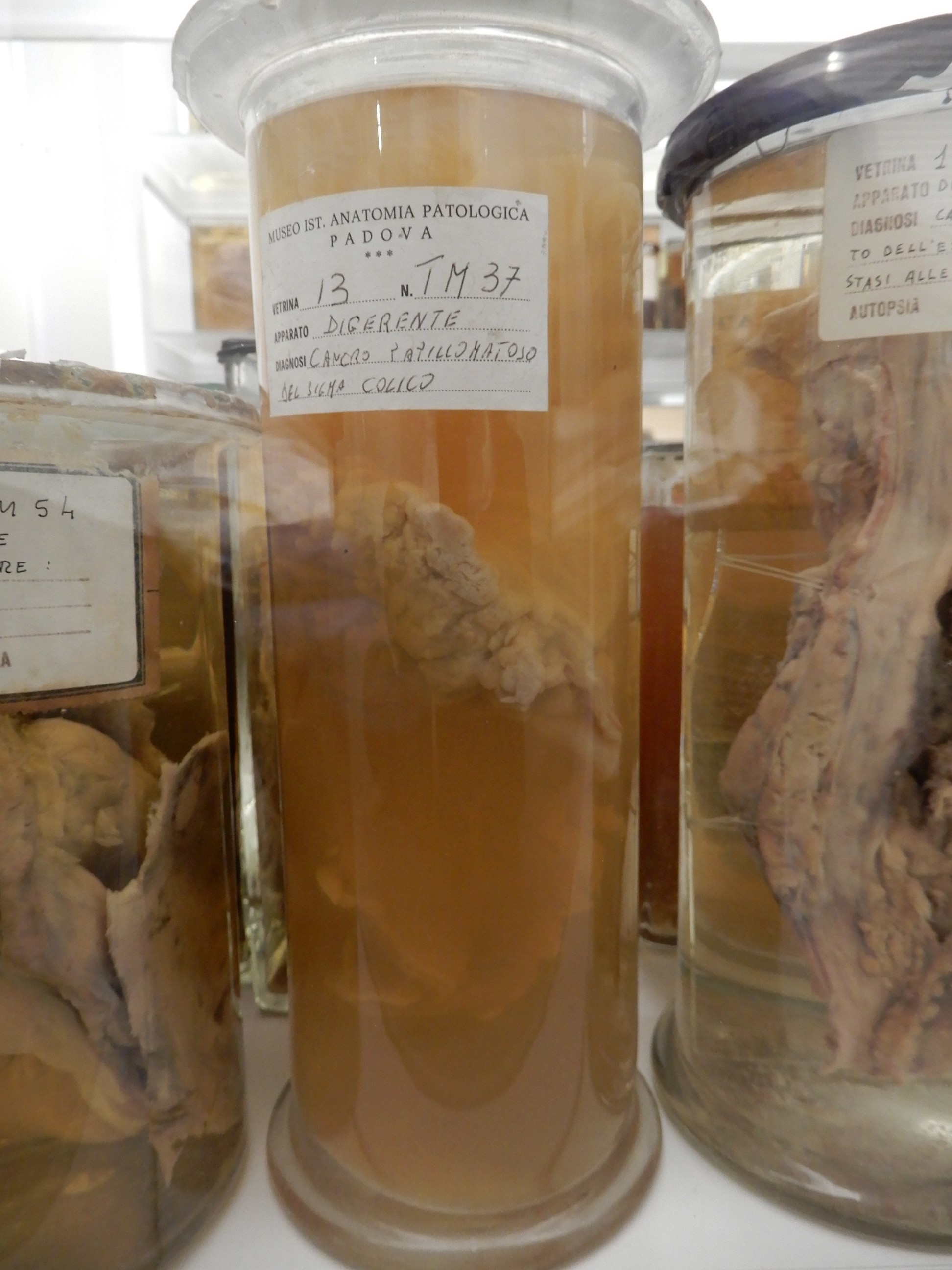 singolo reperto antropologico, preparato anatomico (morfologia alterata per patologia) (XIX-XX)