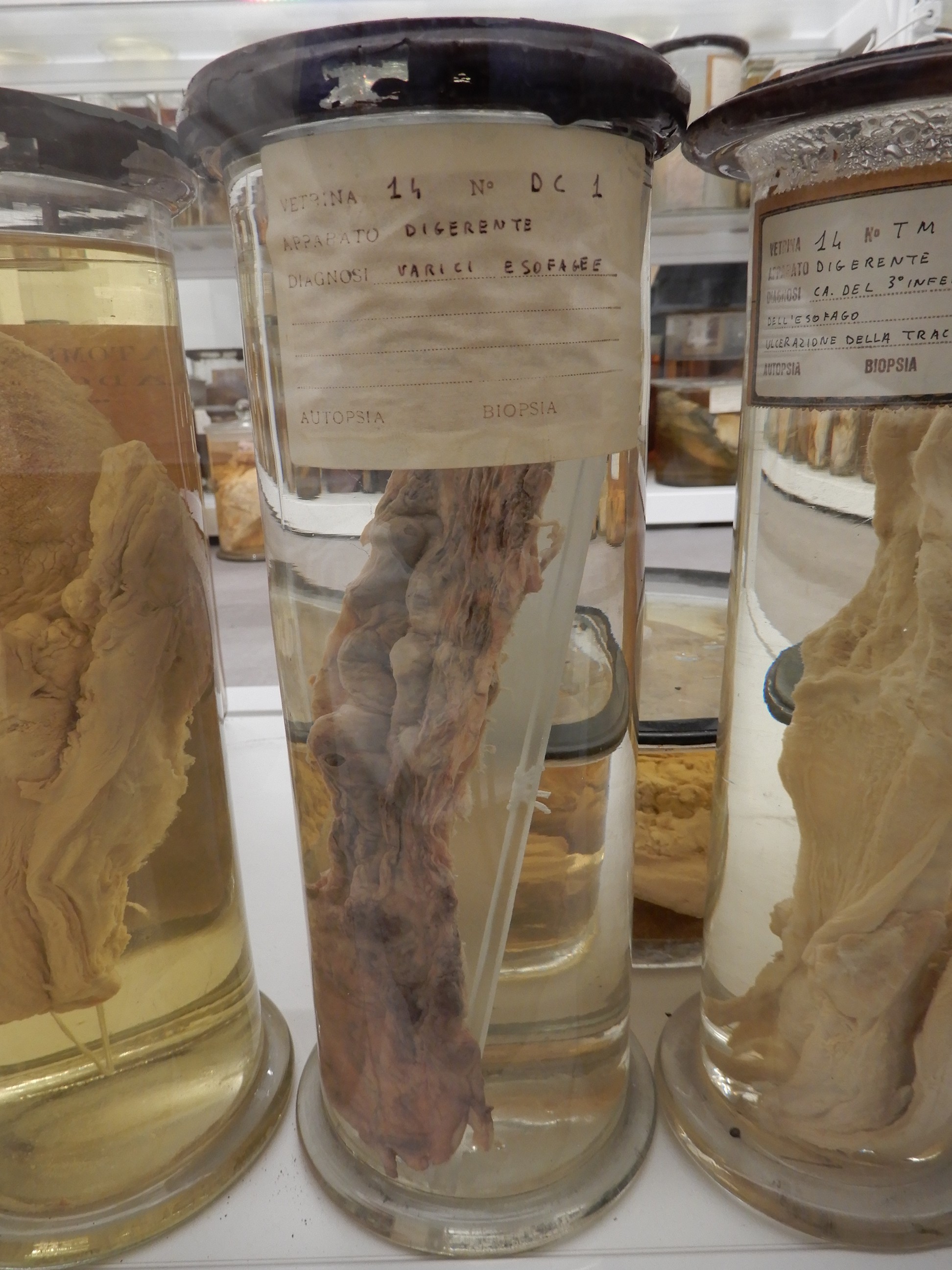 singolo reperto antropologico, preparato anatomico (morfologia alterata per patologia) (XIX-XX)