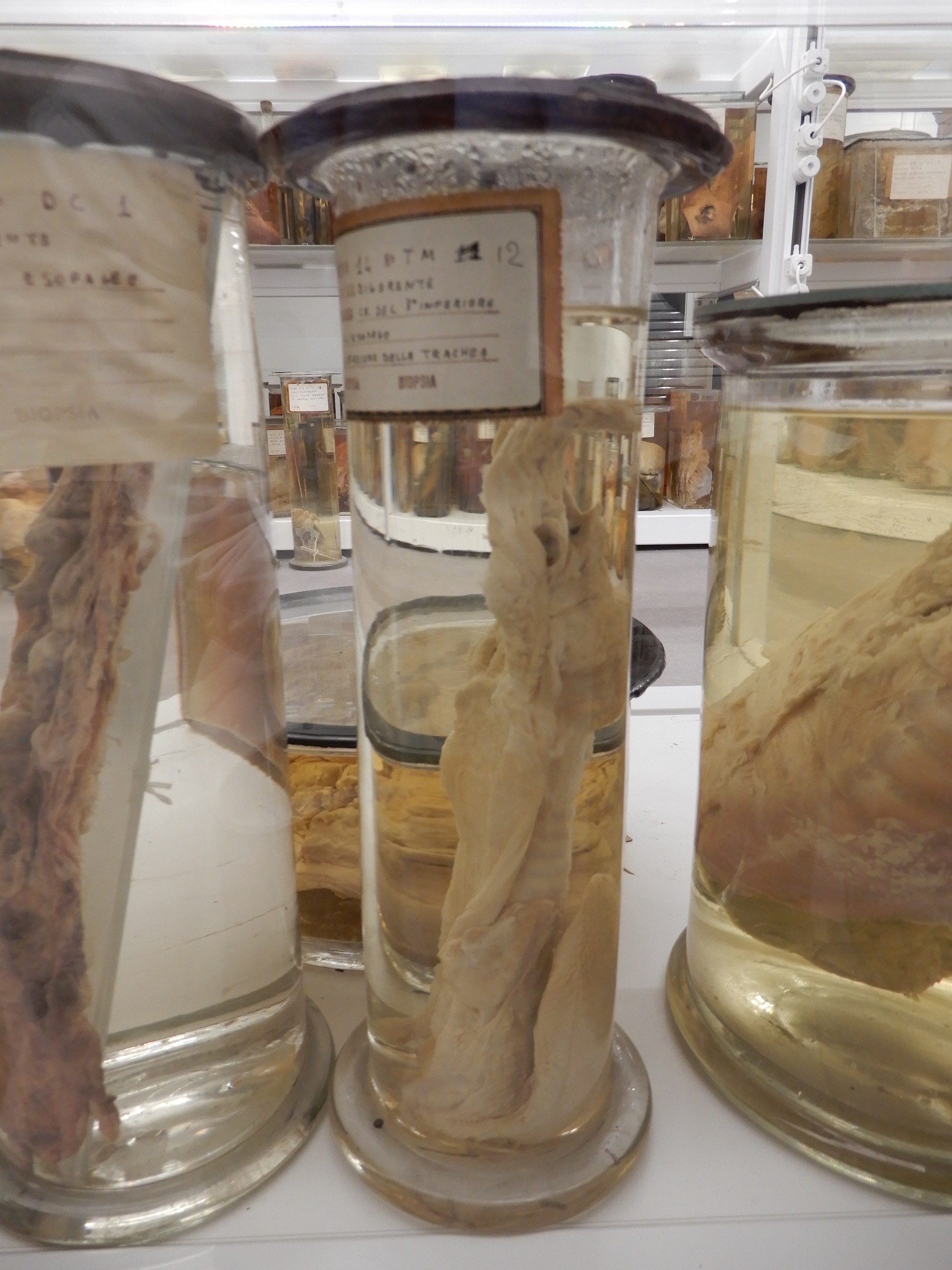 singolo reperto antropologico, preparato anatomico (morfologia alterata per patologia) (XIX-XX)