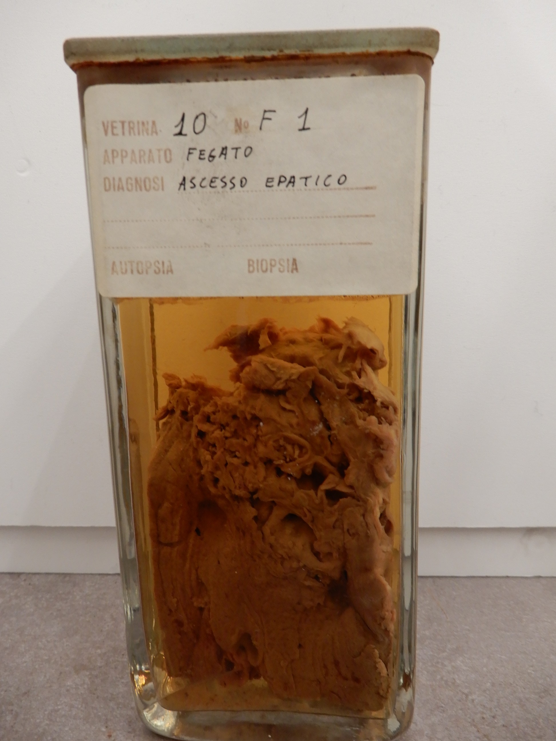 singolo reperto antropologico, preparato anatomico (morfologia alterata per patologia) (XIX-XX)