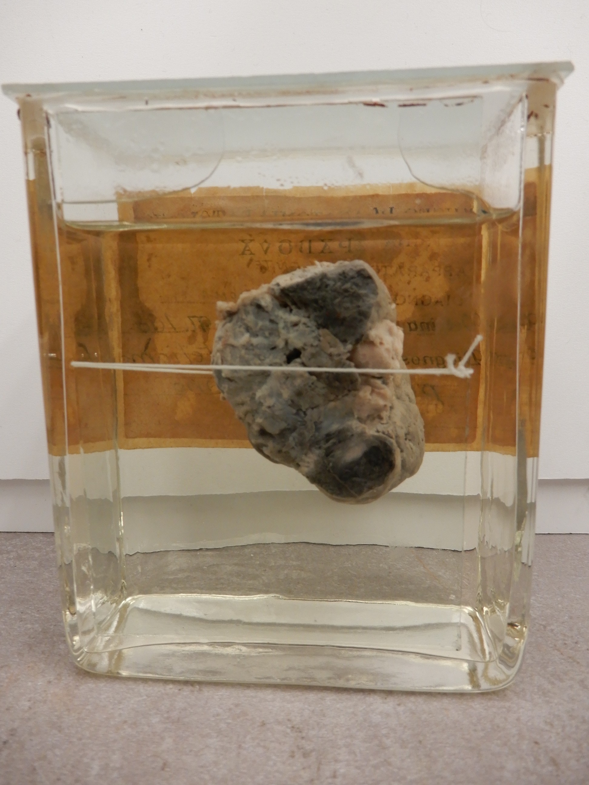 singolo reperto antropologico, preparato anatomico (morfologia alterata per patologia) (XIX-XX)