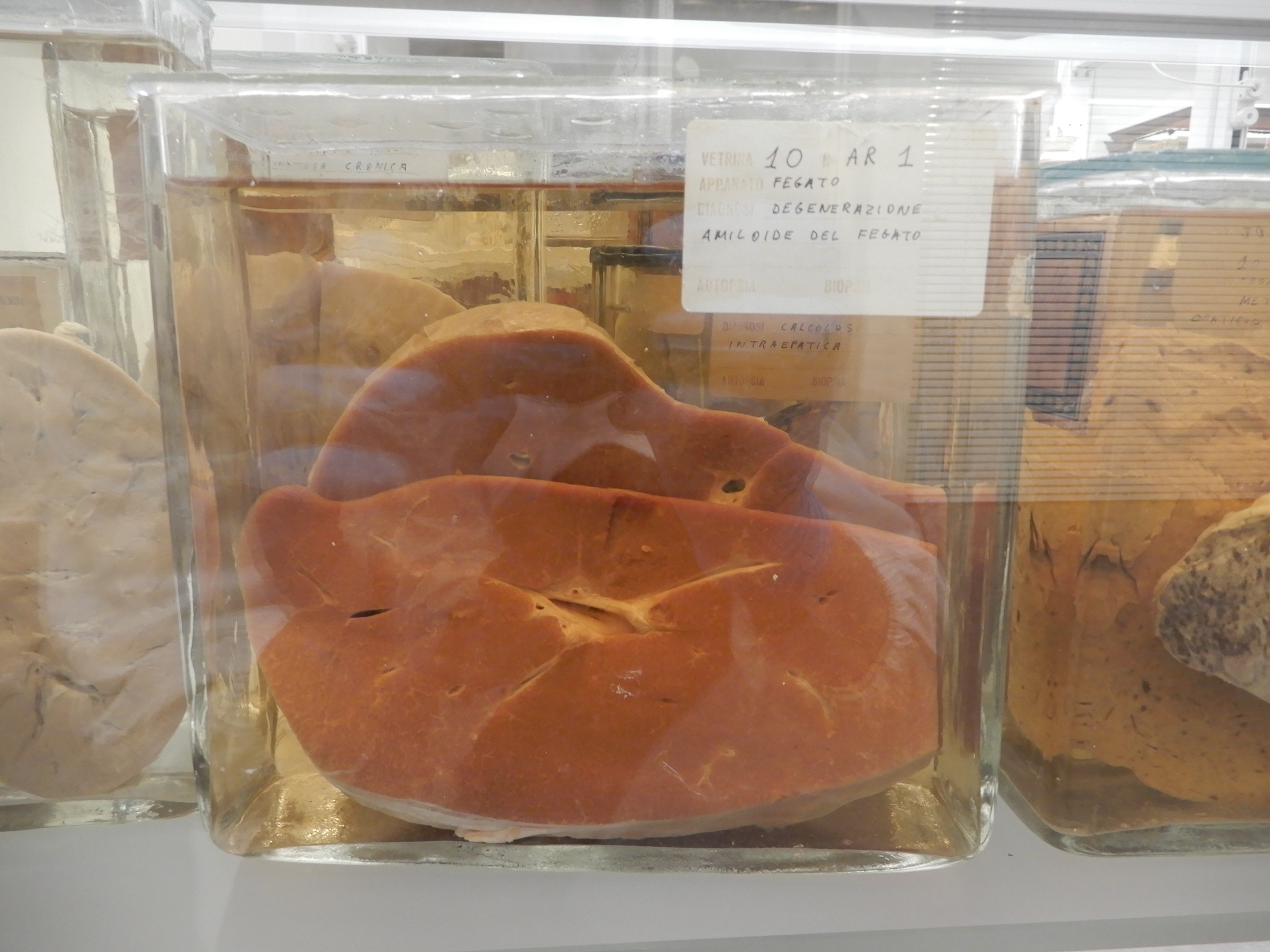 singolo reperto antropologico, preparato anatomico (morfologia alterata per patologia) (XIX-XX)