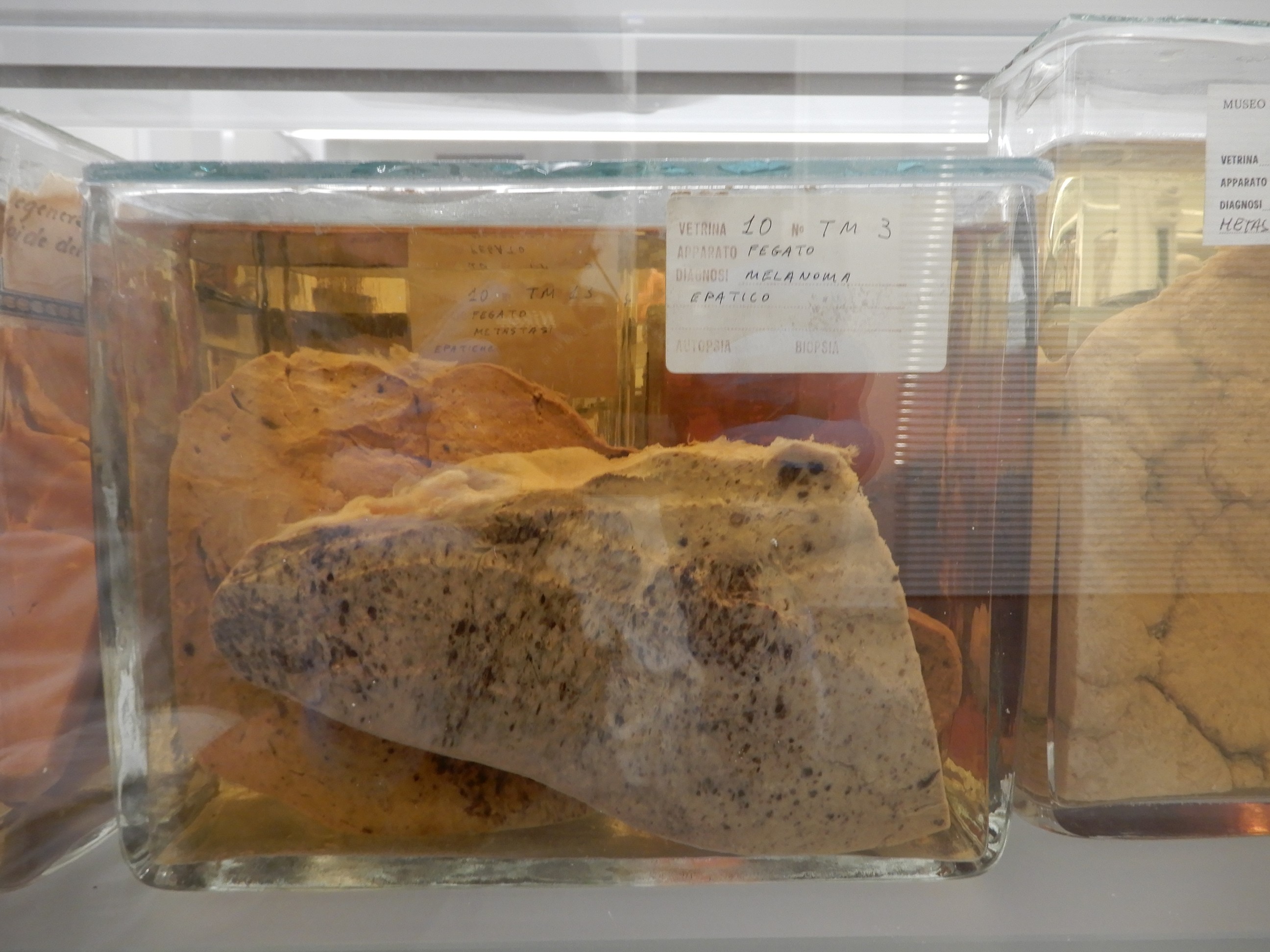 singolo reperto antropologico, preparato anatomico (morfologia alterata per patologia) (XIX-XX)