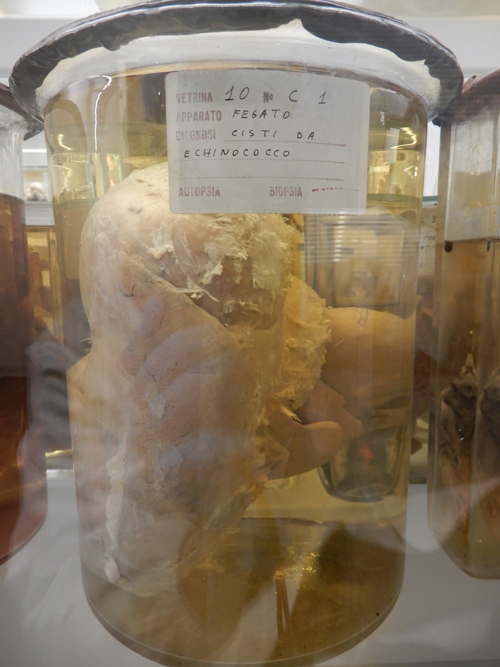 singolo reperto antropologico, preparato anatomico (morfologia alterata per patologia) (XIX-XX)