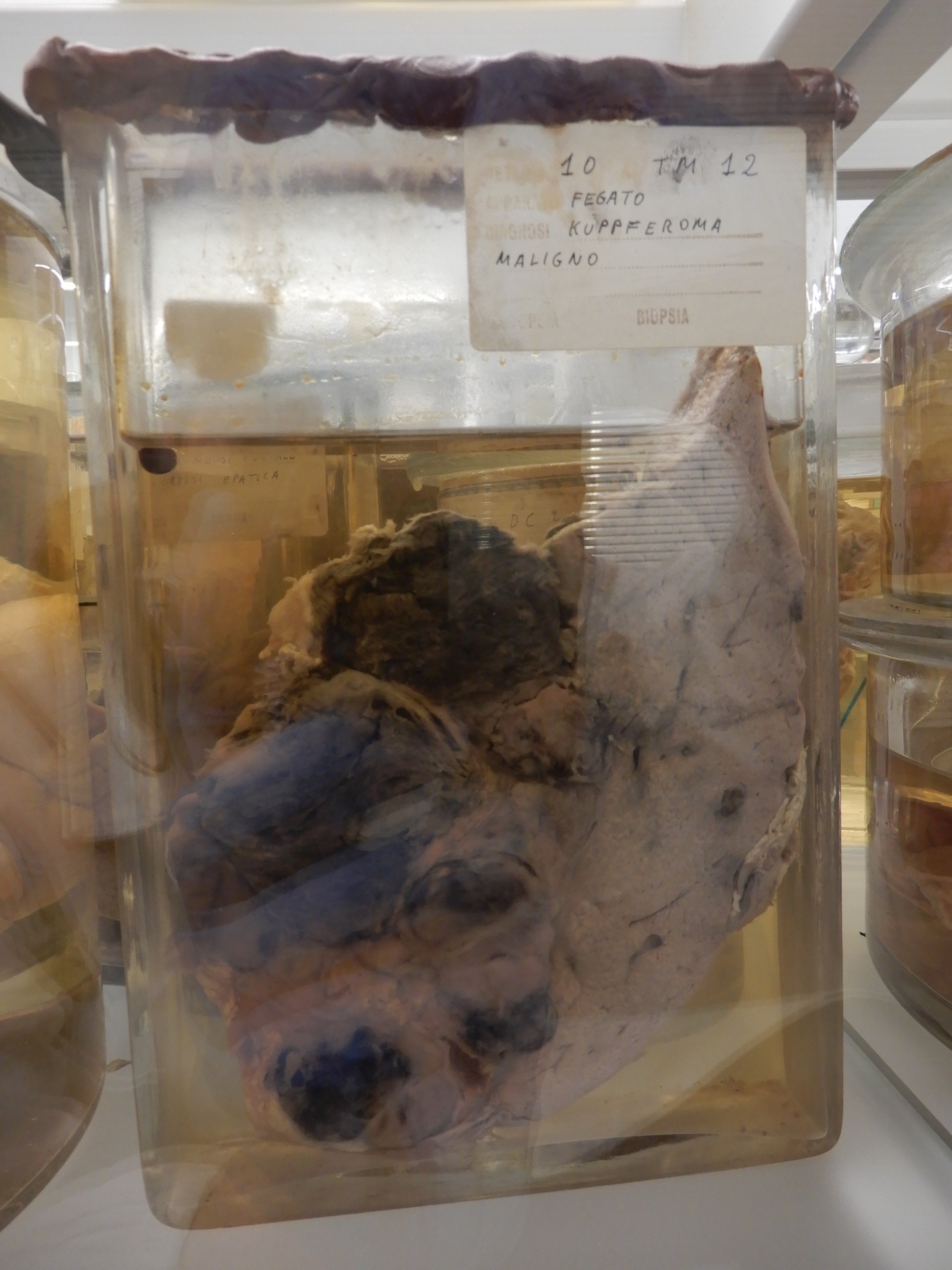 singolo reperto antropologico, preparato anatomico (morfologia alterata per patologia) (XIX-XX)