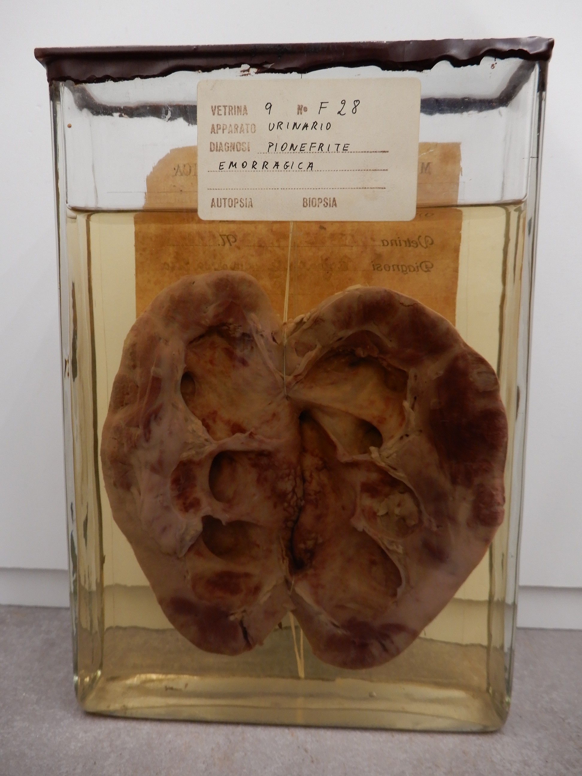 singolo reperto antropologico, preparato anatomico (morfologia alterata per patologia) (XIX-XX)