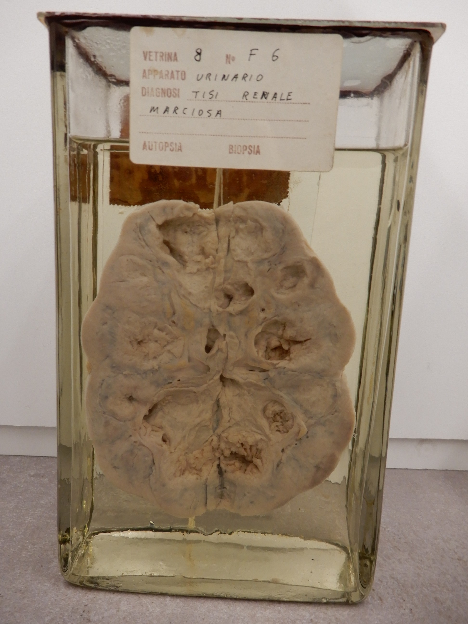 singolo reperto antropologico, preparato anatomico (morfologia alterata per patologia) (XIX-XX)