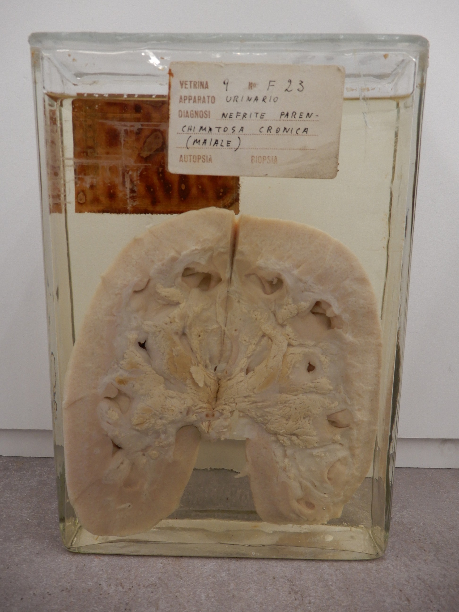 singolo reperto antropologico, preparato anatomico (morfologia alterata per patologia) (XIX-XX)