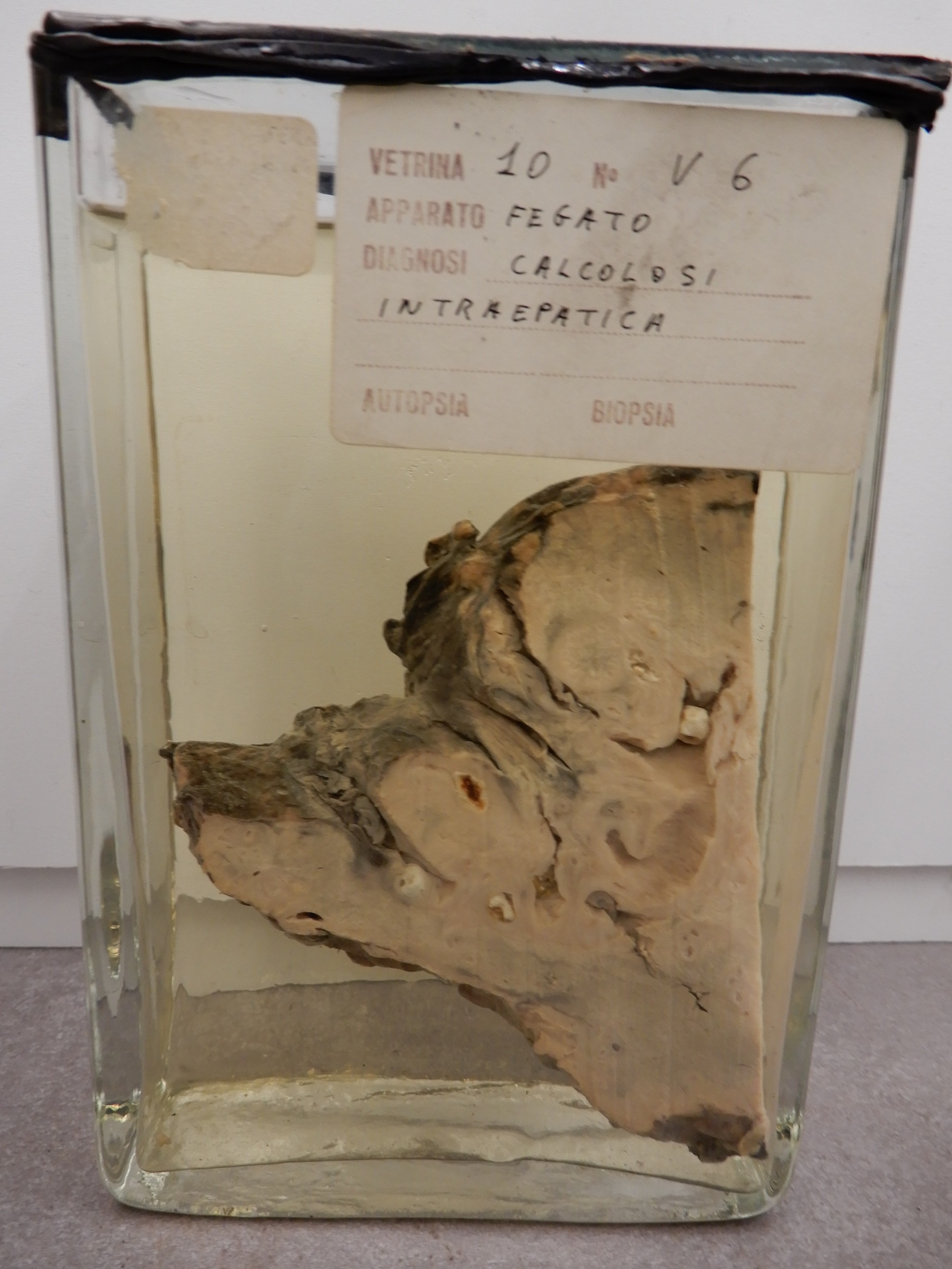 singolo reperto antropologico, preparato anatomico (morfologia alterata per patologia) (XIX-XX)