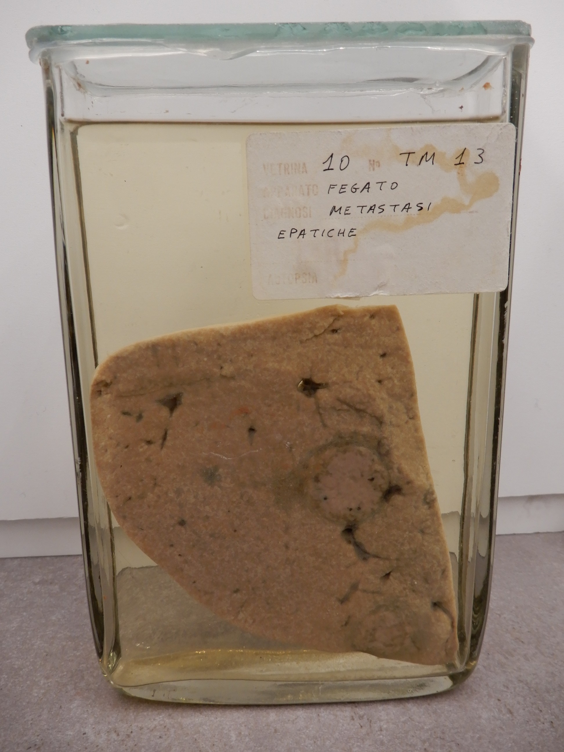 singolo reperto antropologico, preparato anatomico (morfologia alterata per patologia) (XIX-XX)