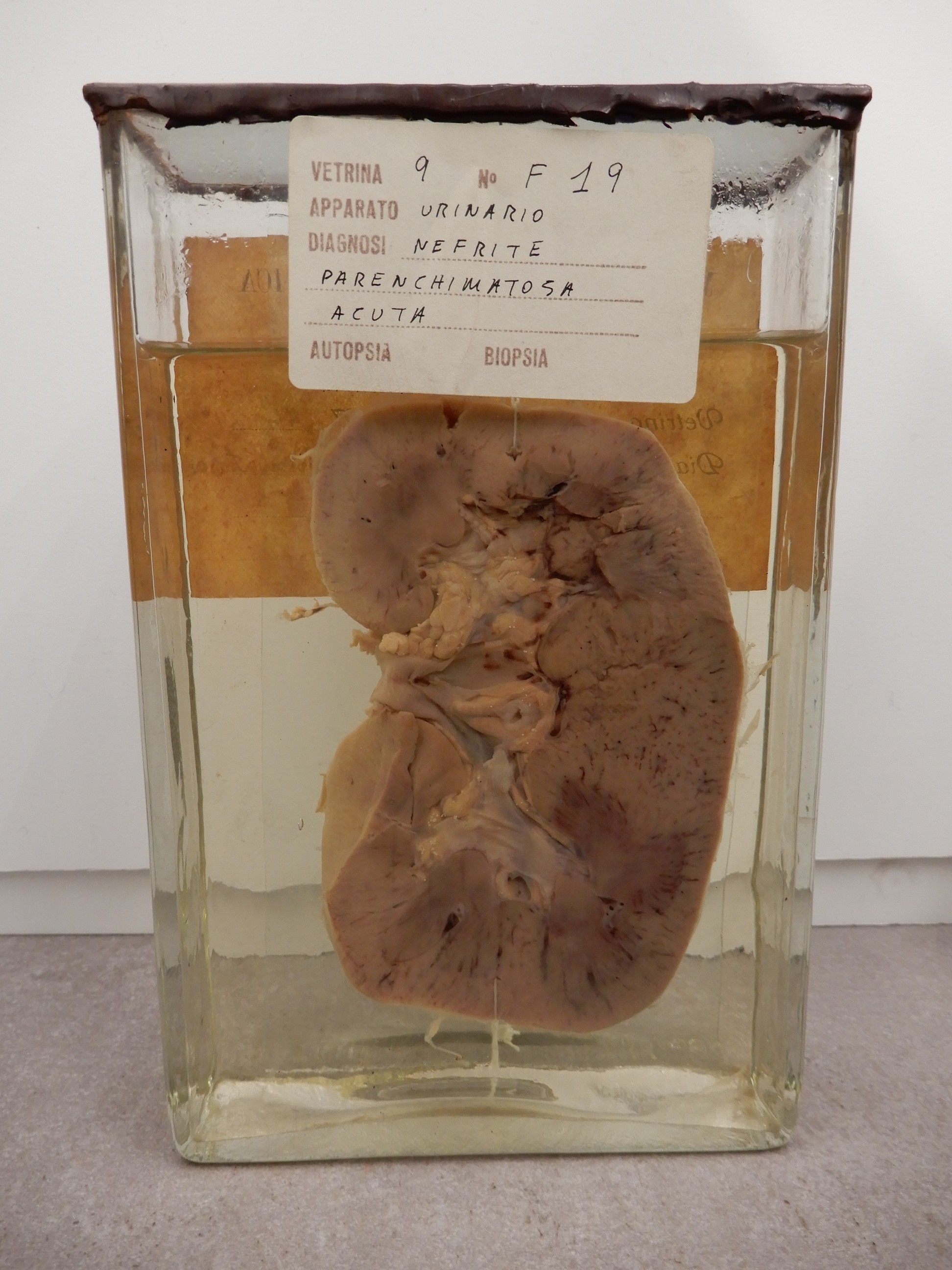 singolo reperto antropologico, preparato anatomico (morfologia alterata per patologia) (XIX-XX)