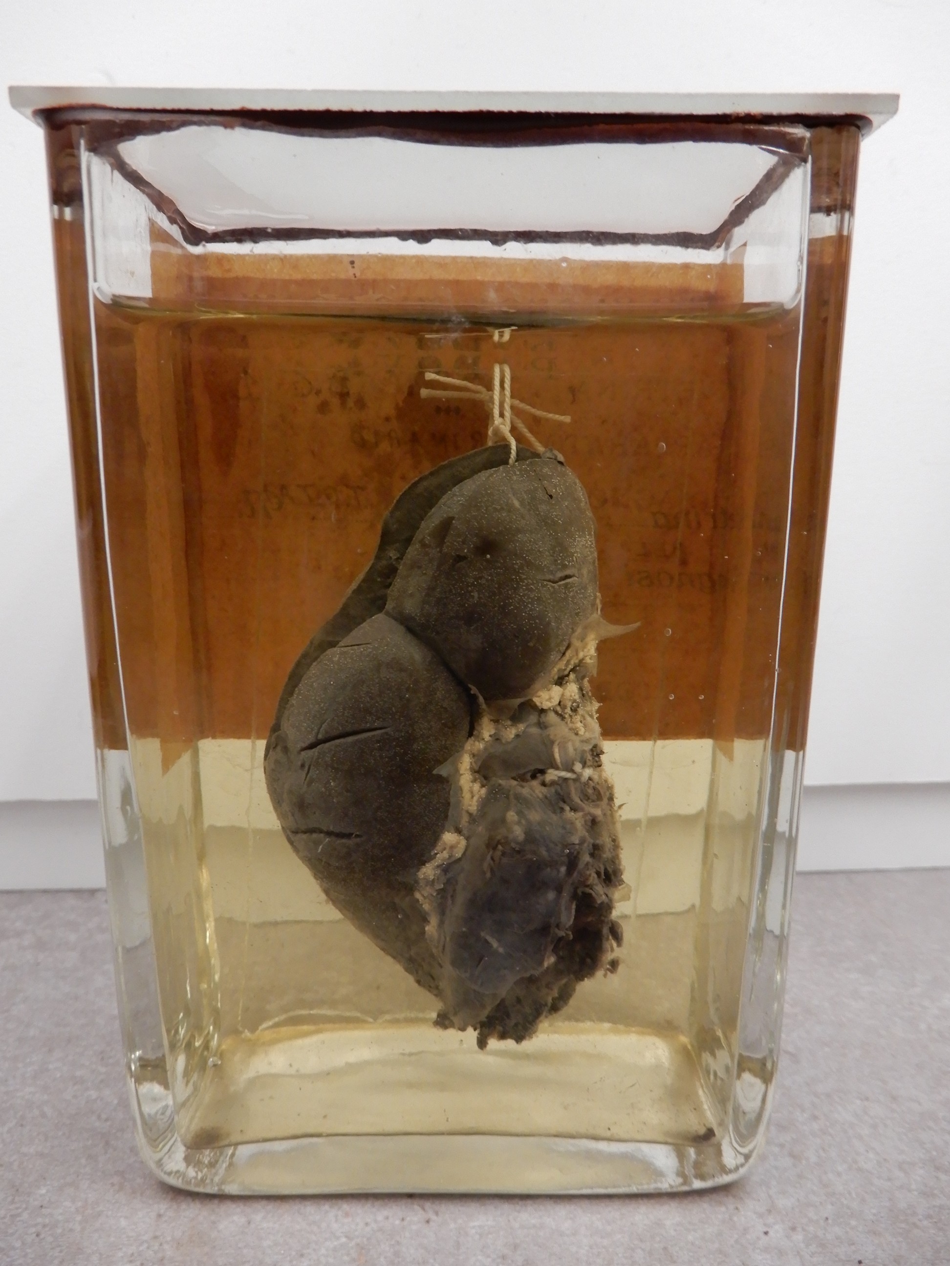 singolo reperto antropologico, preparato anatomico (morfologia alterata per patologia) (XIX-XX)