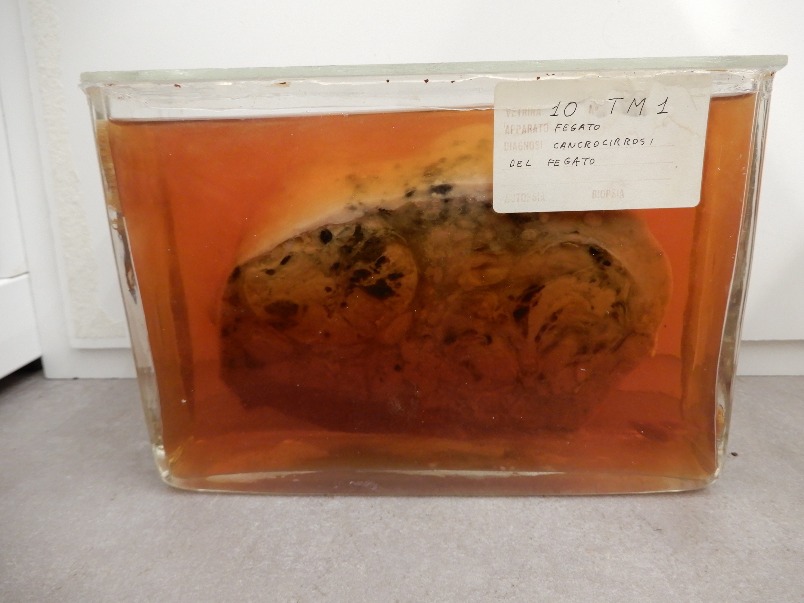 singolo reperto antropologico, preparato anatomico (morfologia alterata per patologia) (XIX-XX)