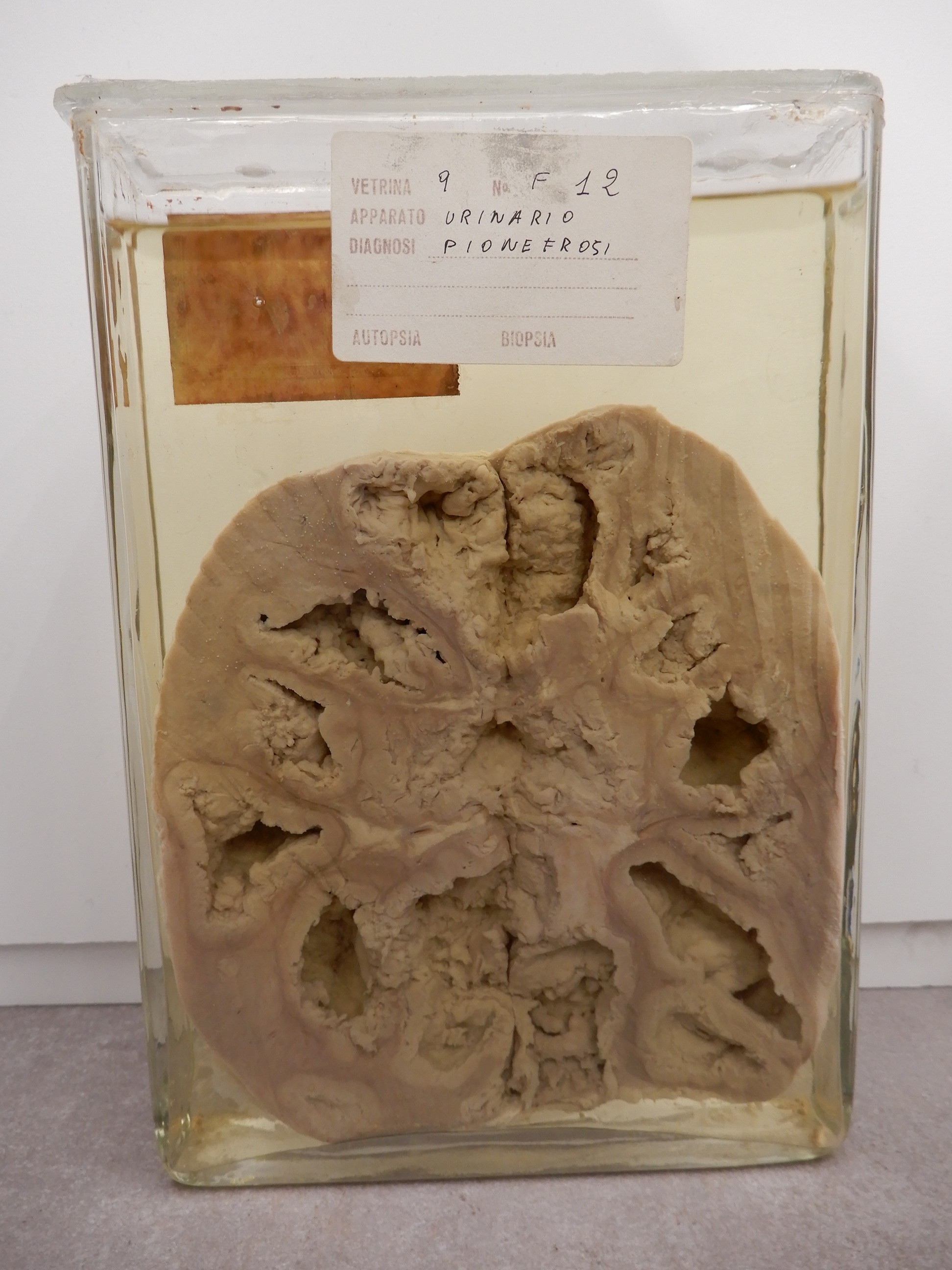 singolo reperto antropologico, preparato anatomico (morfologia alterata per patologia) (XIX-XX)