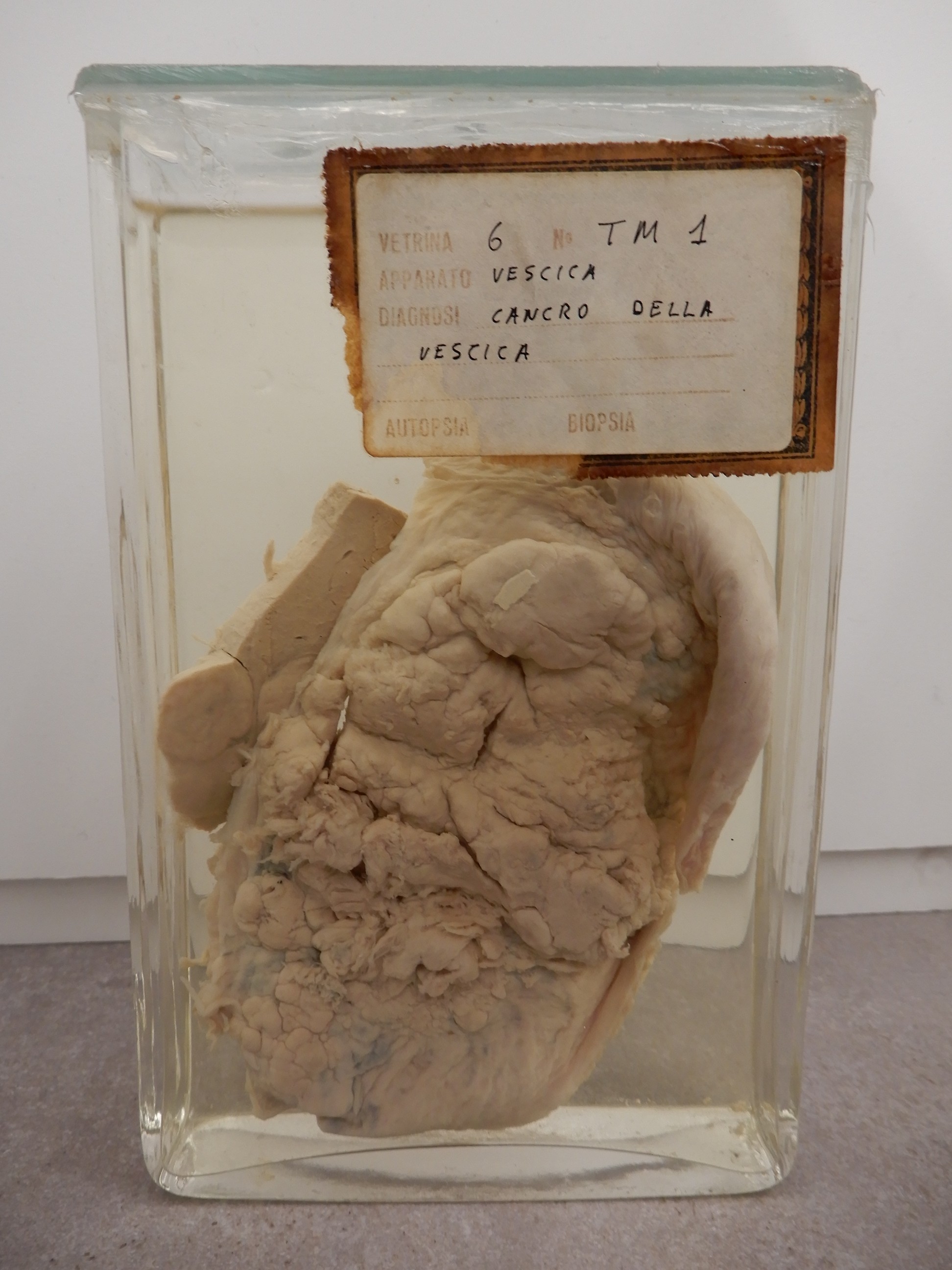 singolo reperto antropologico, preparato anatomico (morfologia alterata per patologia) (XIX-XX)