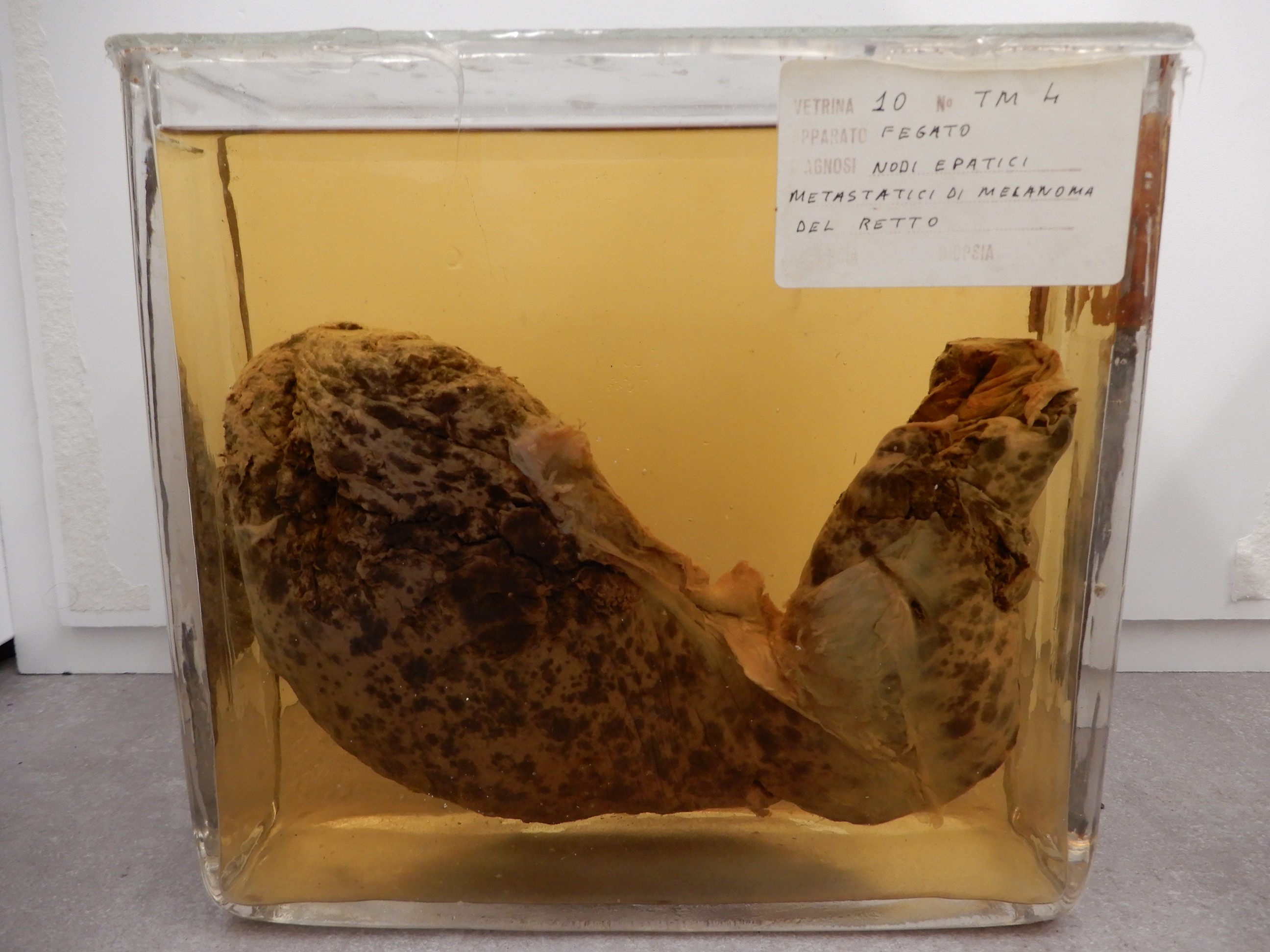 singolo reperto antropologico, preparato anatomico (morfologia alterata per patologia) (XIX-XX)