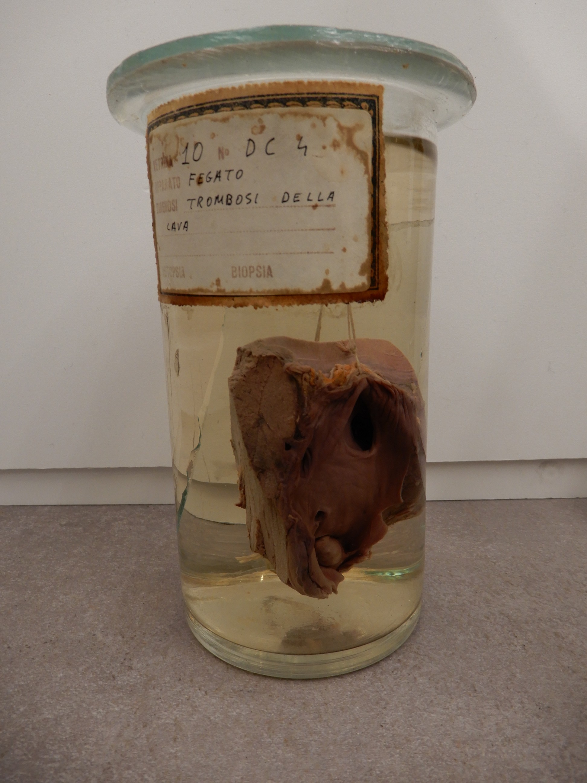 singolo reperto antropologico, preparato anatomico (morfologia alterata per patologia) (XIX-XX)