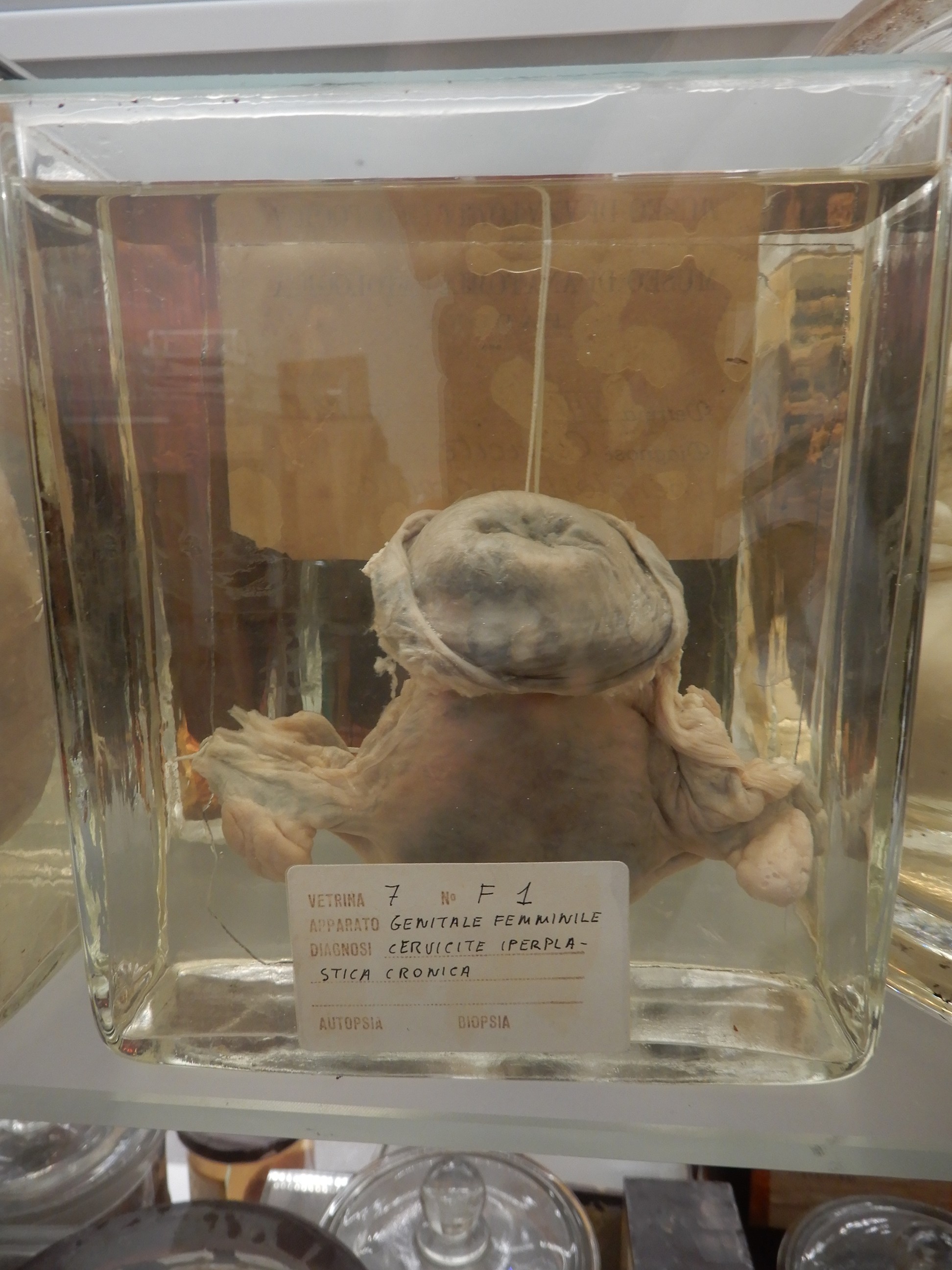 singolo reperto antropologico, preparato anatomico (morfologia alterata per patologia) (XIX-XX)