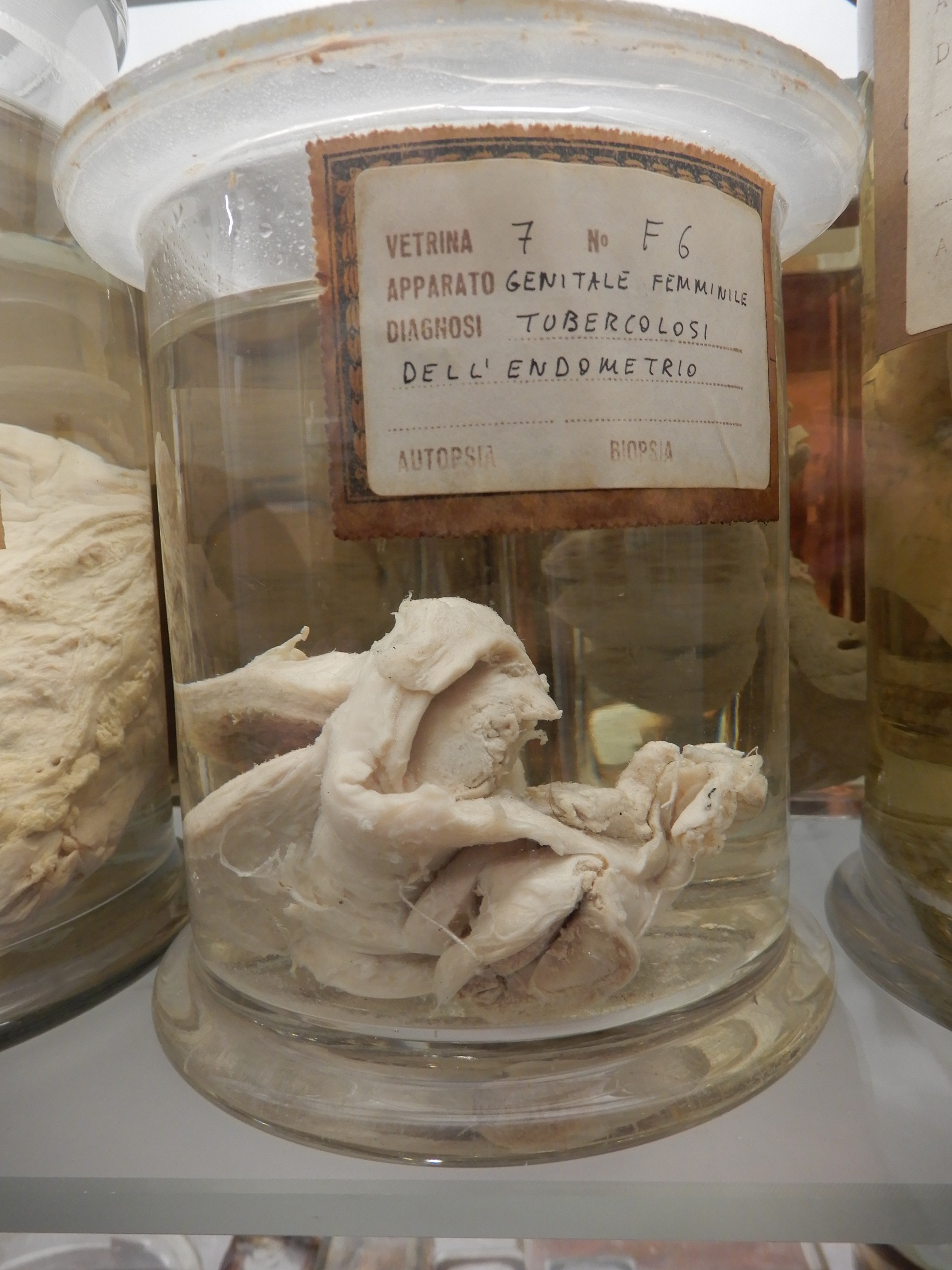 singolo reperto antropologico, preparato anatomico (morfologia alterata per patologia) (XIX-XX)