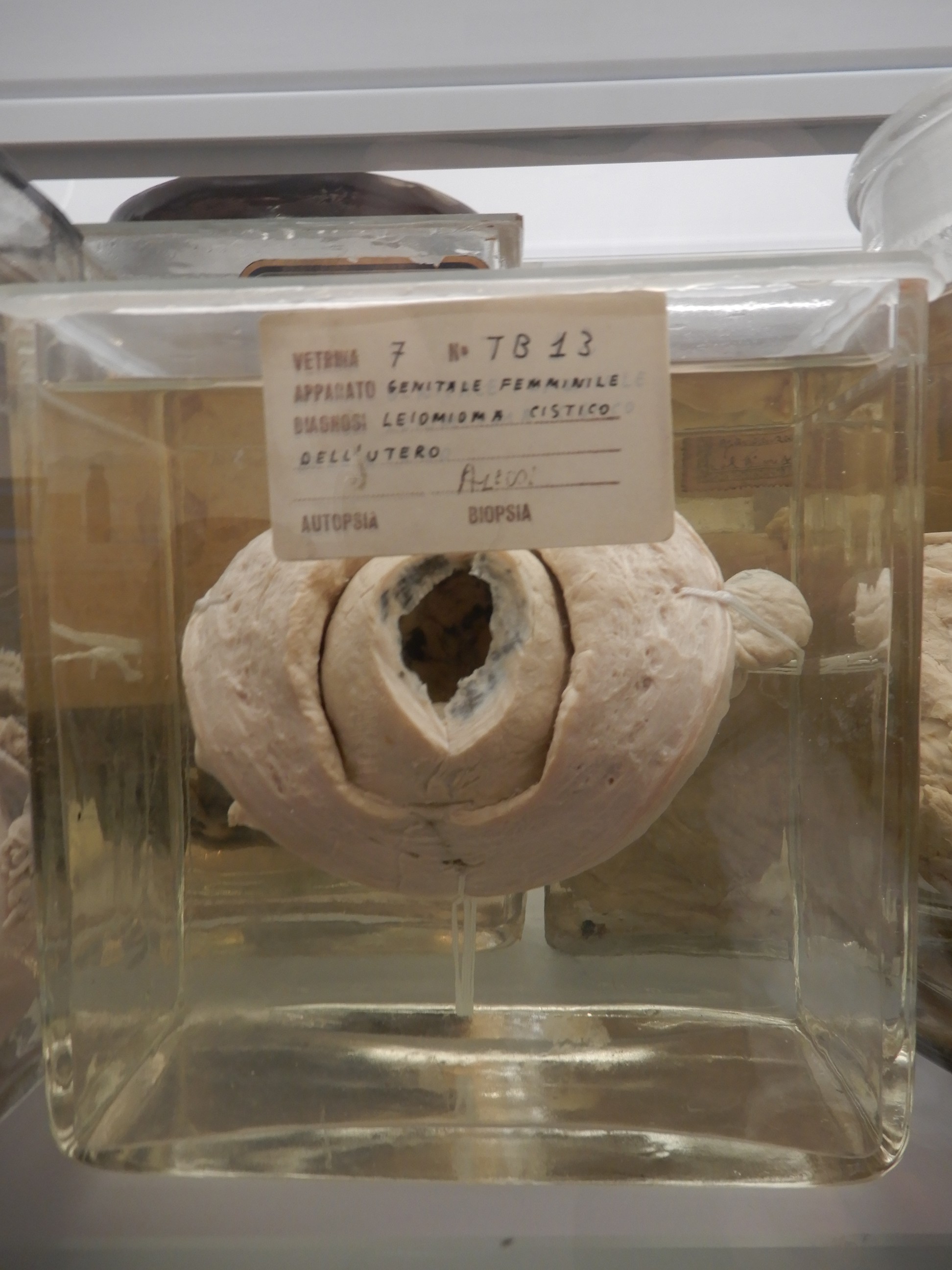 singolo reperto antropologico, preparato anatomico (morfologia alterata per patologia) (XIX-XX)