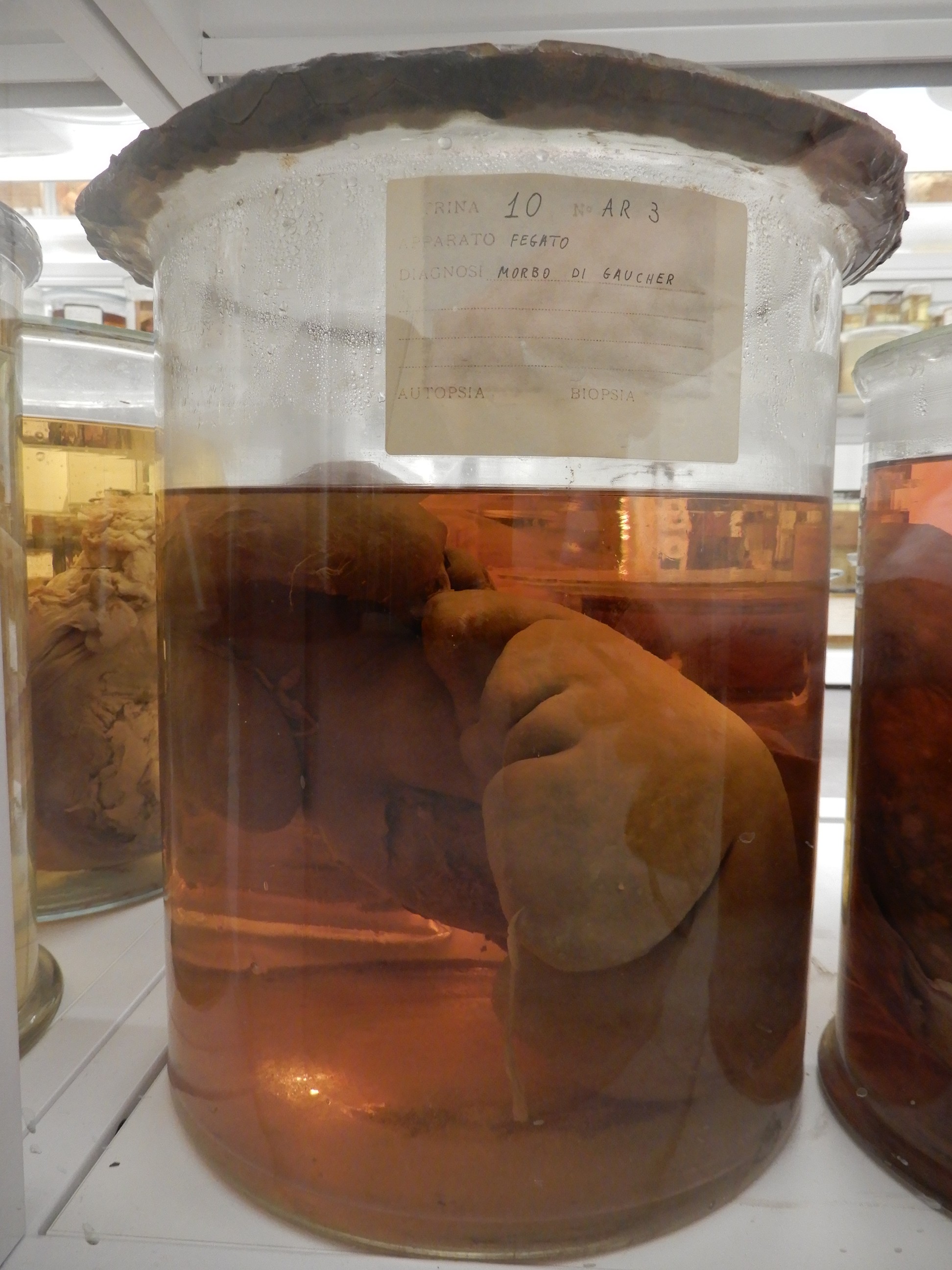 singolo reperto antropologico, preparato anatomico (morfologia alterata per patologia) (XIX-XX)