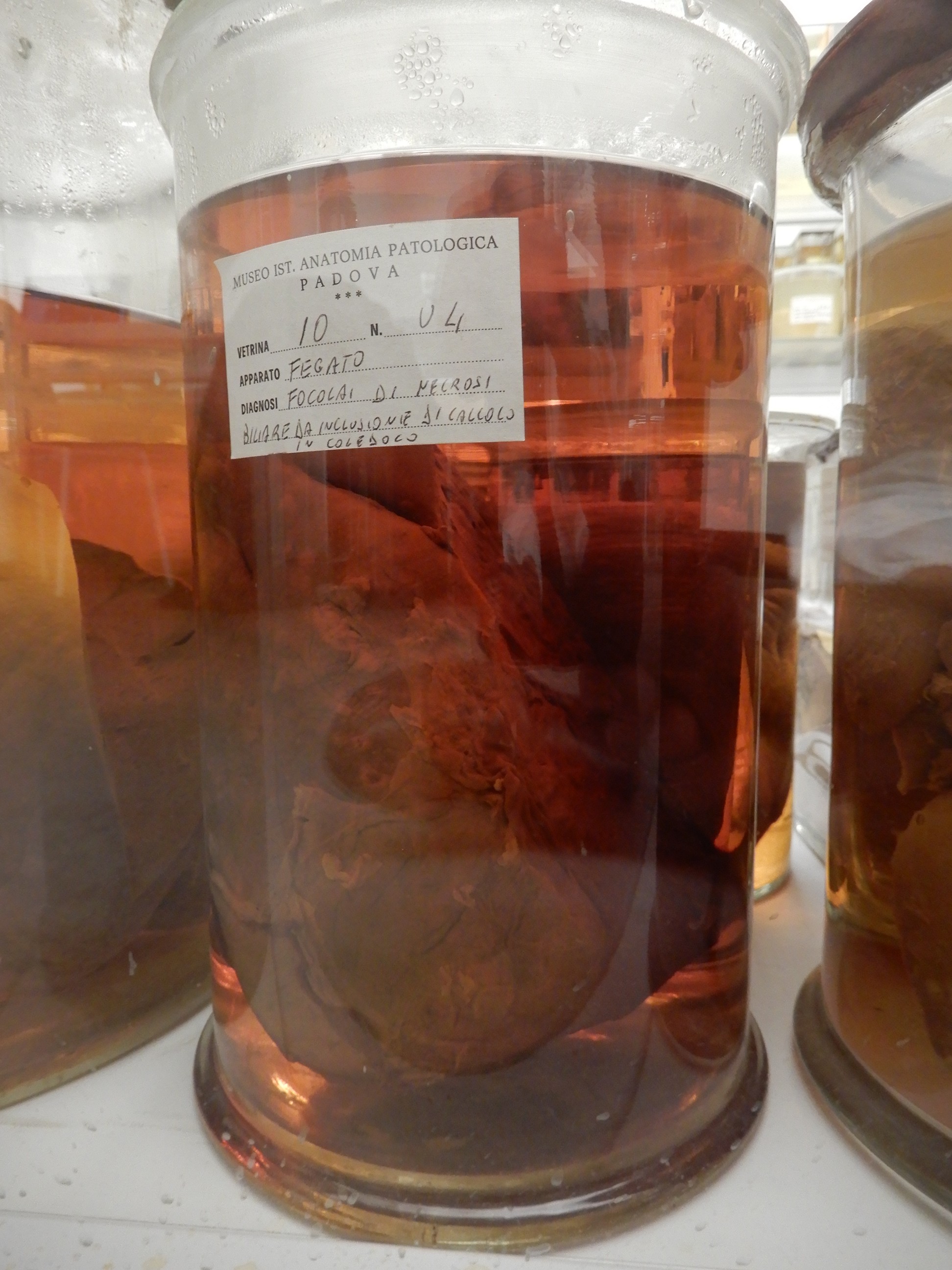 singolo reperto antropologico, preparato anatomico (morfologia alterata per patologia) (XIX-XX)