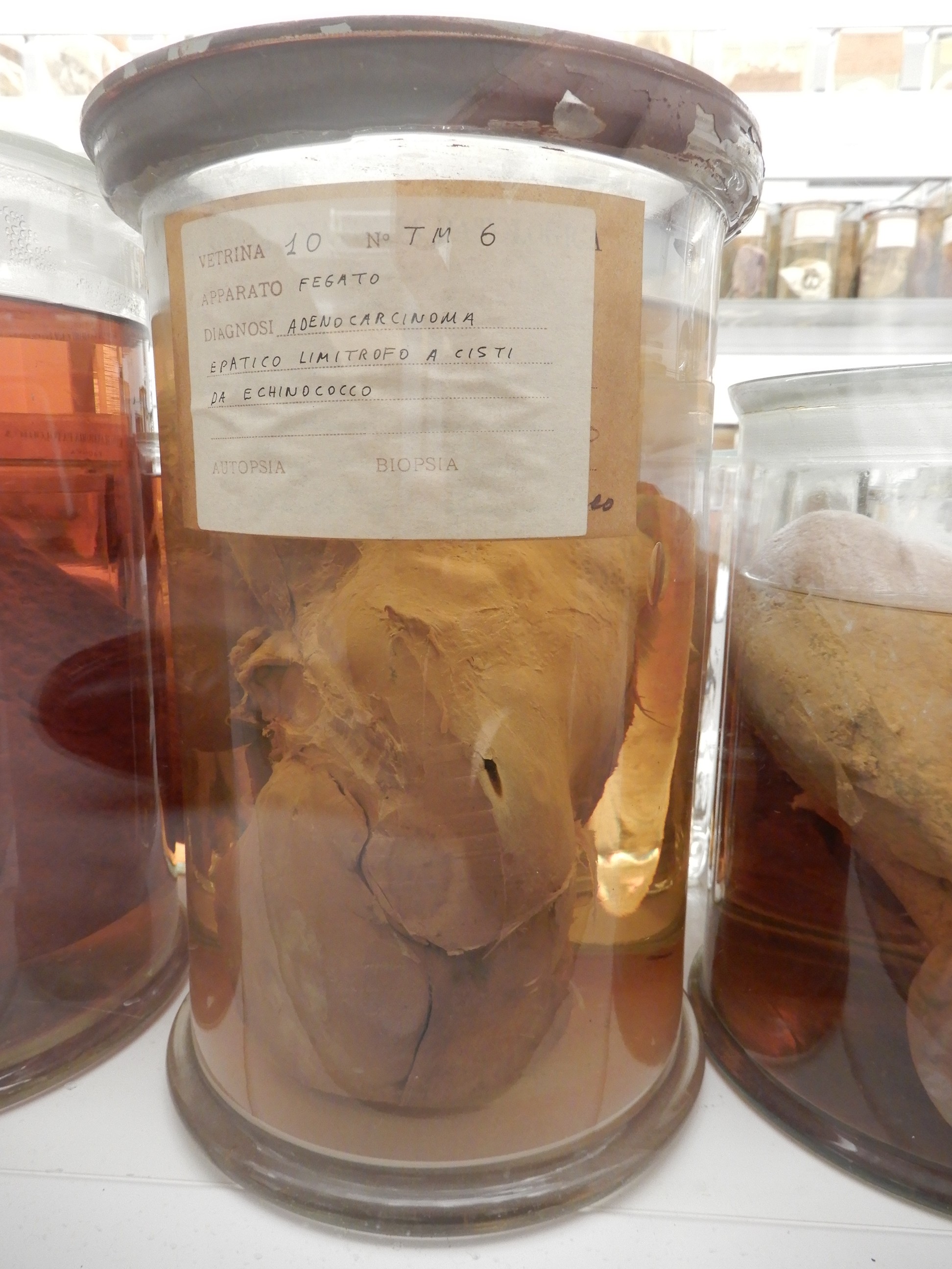 singolo reperto antropologico, preparato anatomico (morfologia alterata per patologia) (XIX-XX)