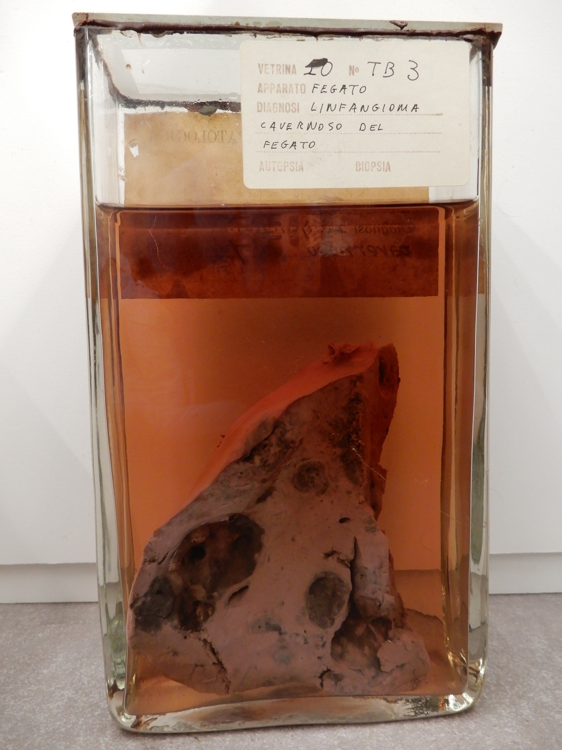 singolo reperto antropologico, preparato anatomico (morfologia alterata per patologia) (XIX-XX)