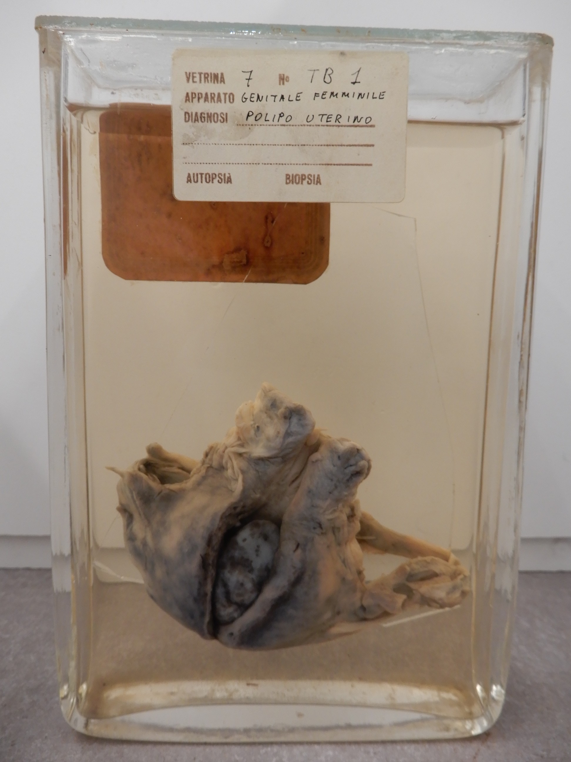 singolo reperto antropologico, preparato anatomico (morfologia alterata per patologia) (XIX-XX)