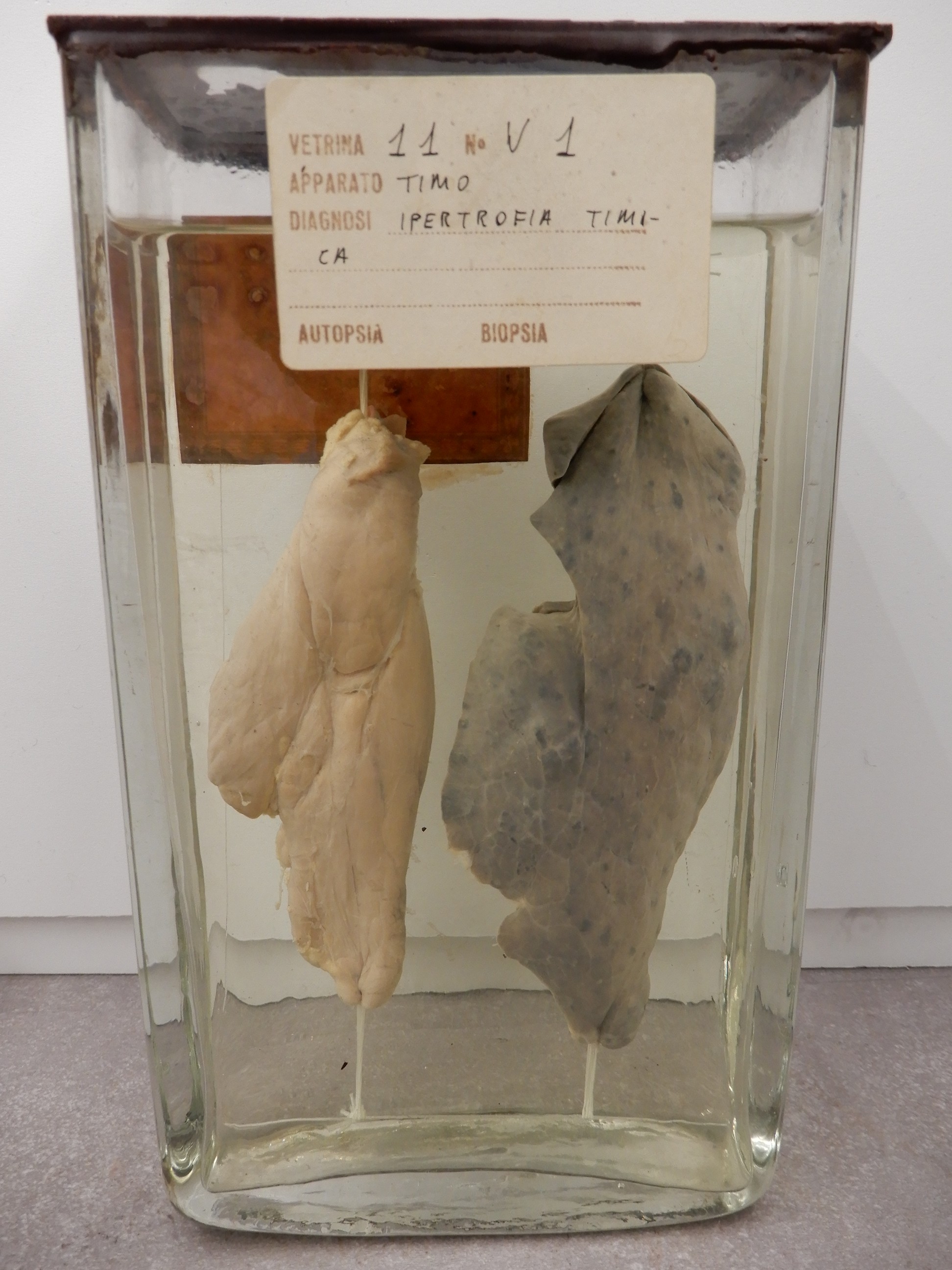 singolo reperto antropologico, preparato anatomico (morfologia alterata per patologia) (XIX-XX)