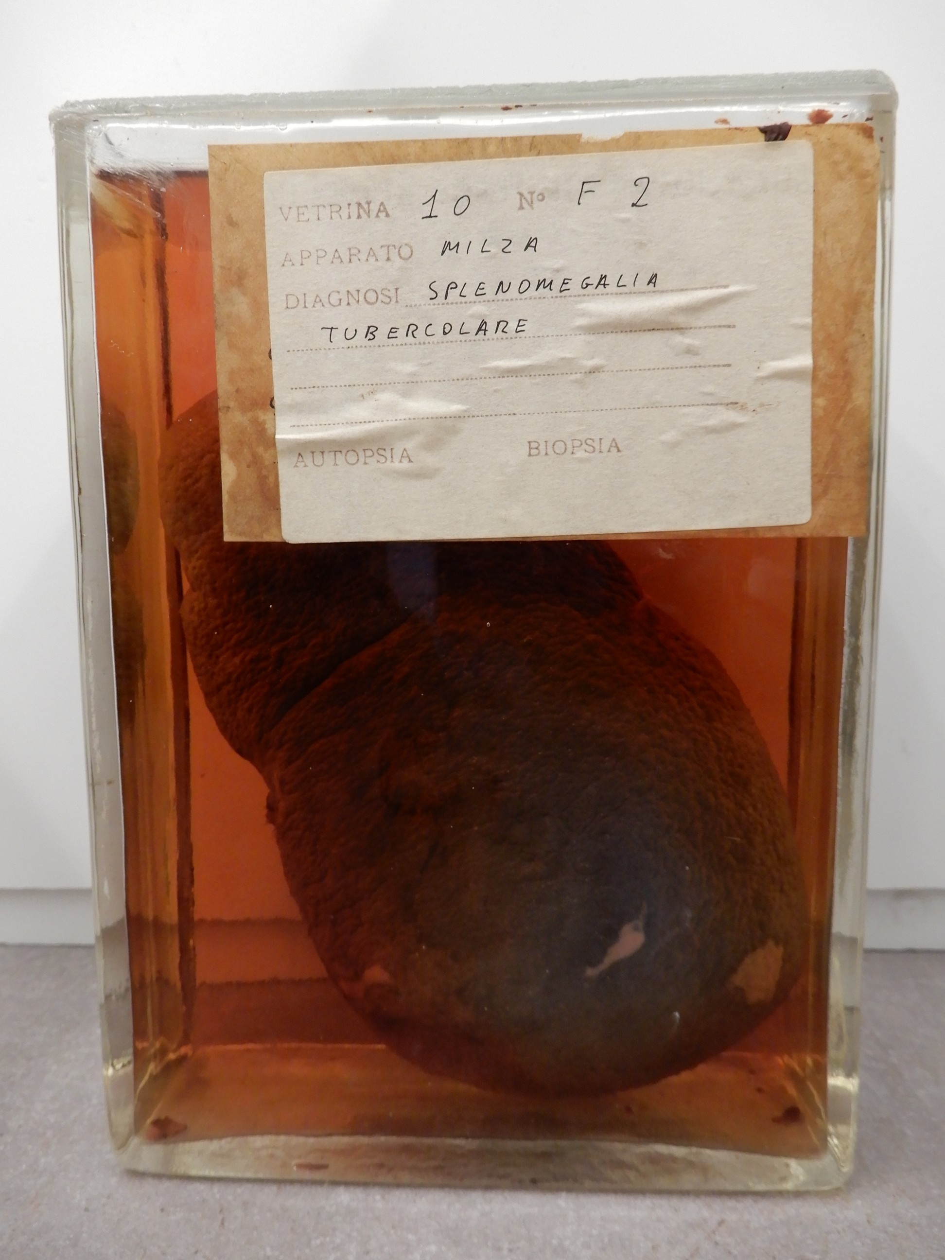 singolo reperto antropologico, preparato anatomico (morfologia alterata per patologia) (XIX-XX)