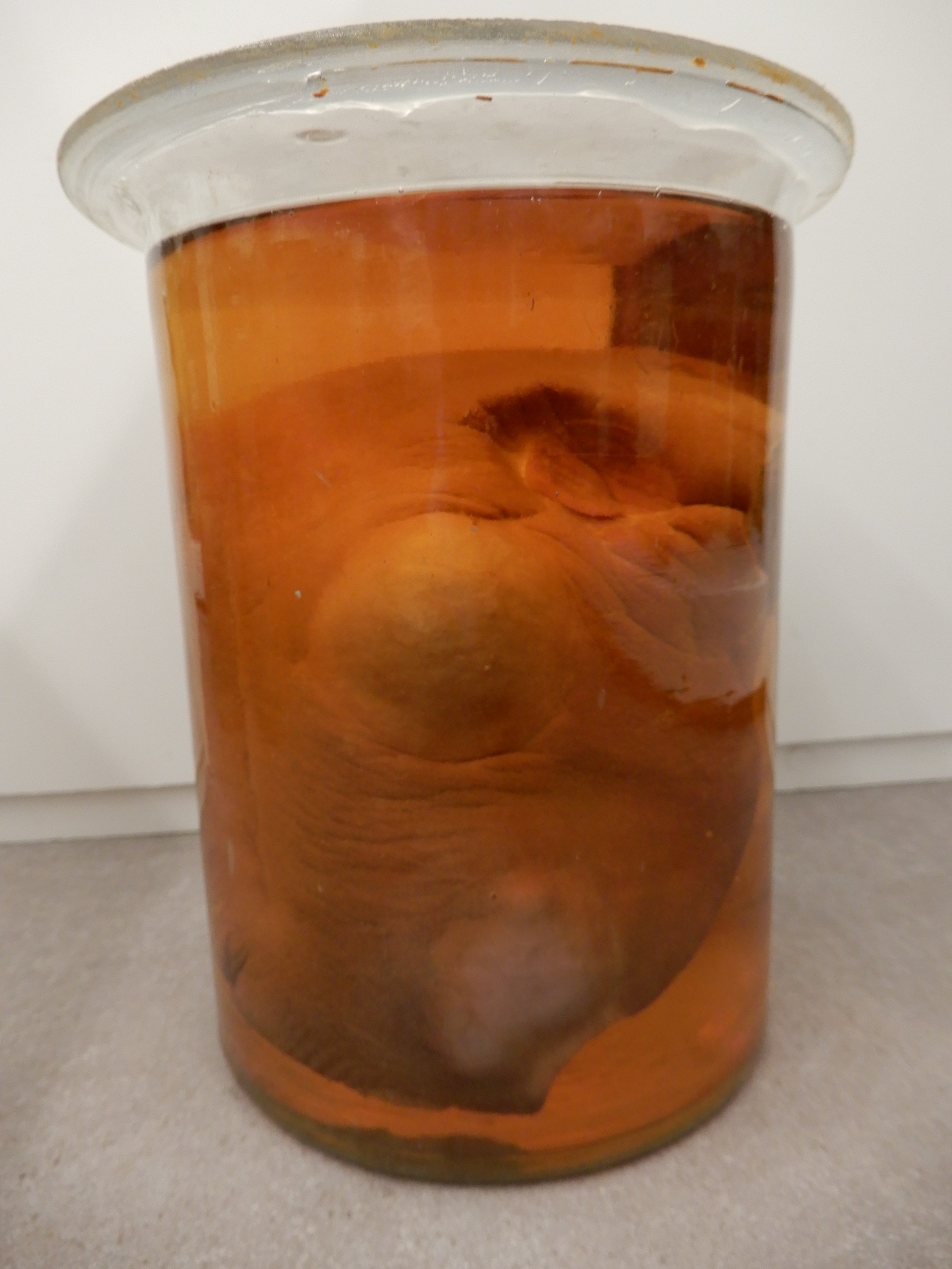 singolo reperto antropologico, preparato anatomico (morfologia alterata per patologia) (XIX-XX)