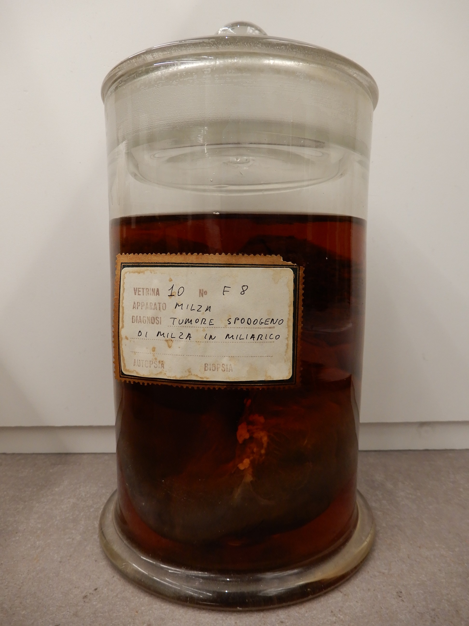 singolo reperto antropologico, preparato anatomico (morfologia alterata per patologia) (XIX-XX)