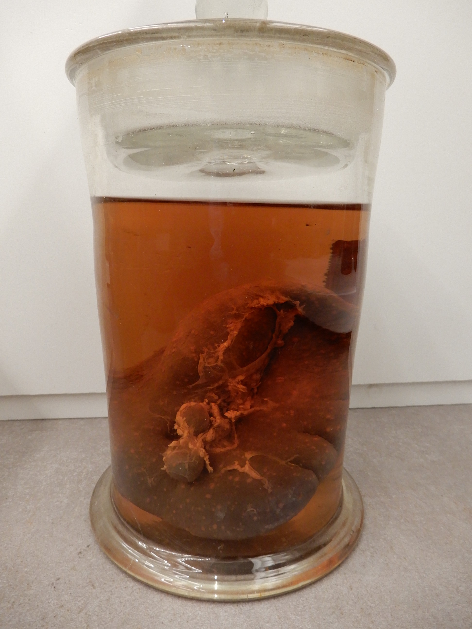 singolo reperto antropologico, preparato anatomico (morfologia alterata per patologia) (XIX-XX)