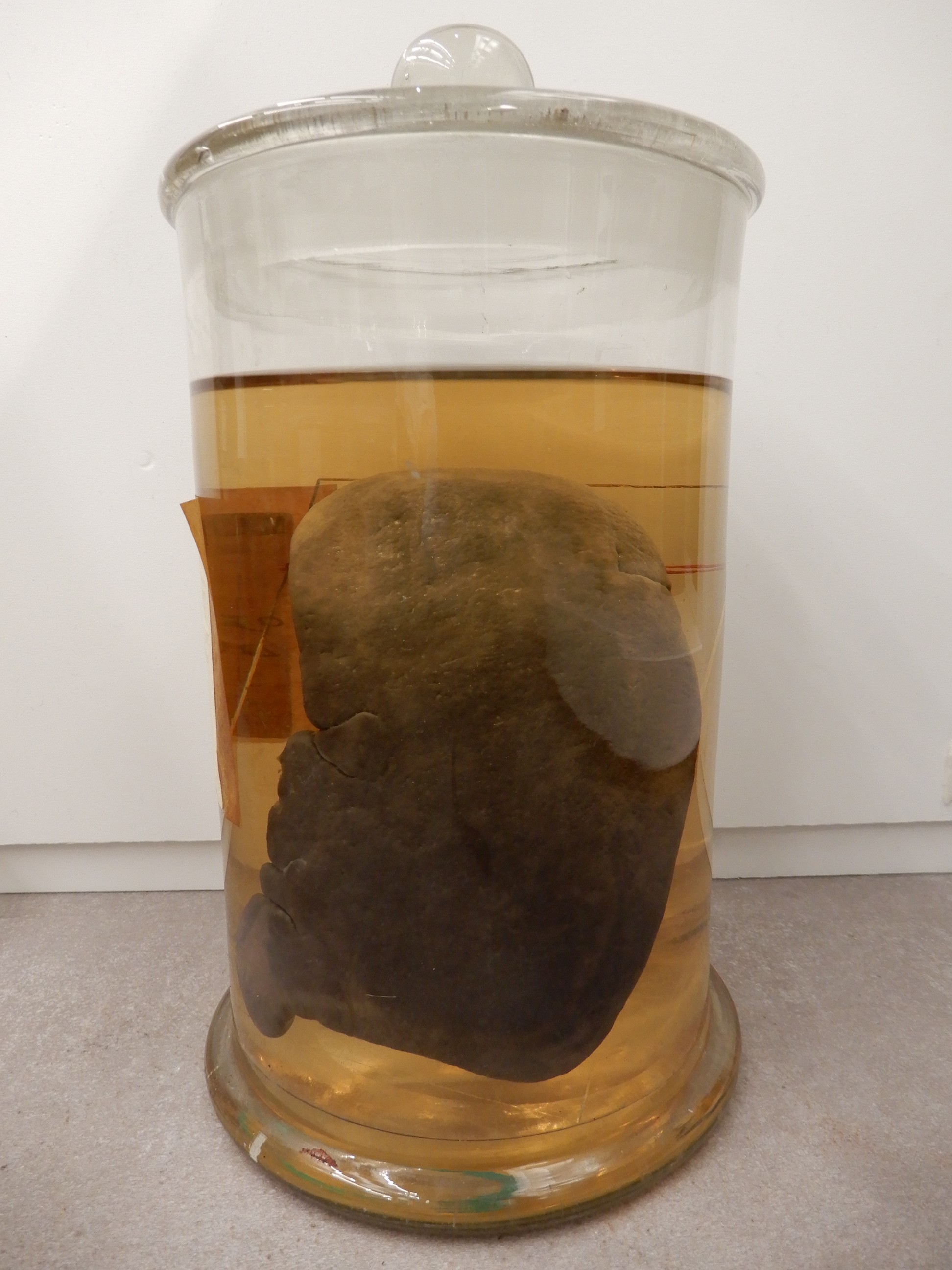 singolo reperto antropologico, preparato anatomico (morfologia alterata per patologia) (XIX-XX)