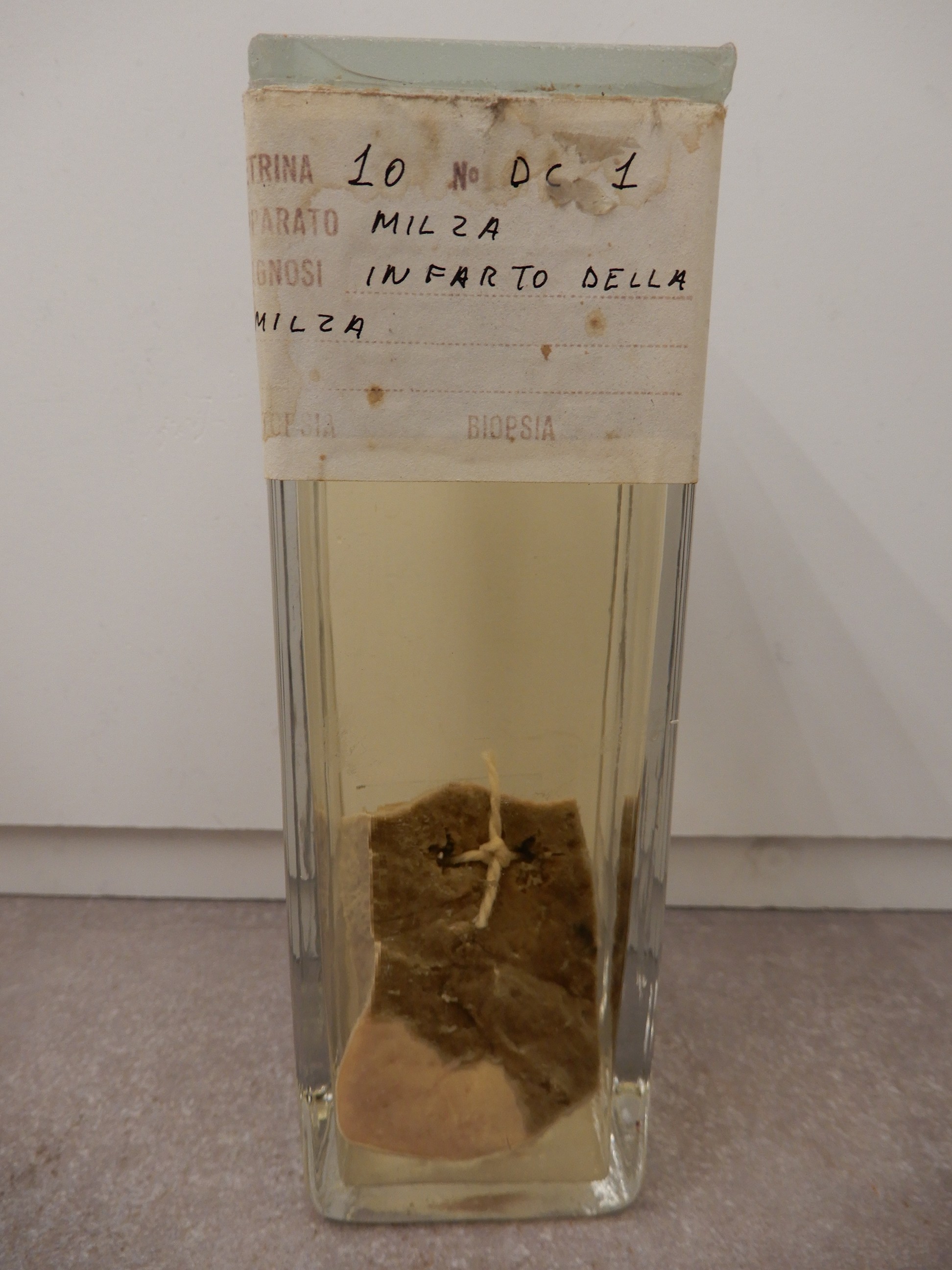 singolo reperto antropologico, preparato anatomico (morfologia alterata per patologia) (XIX-XX)