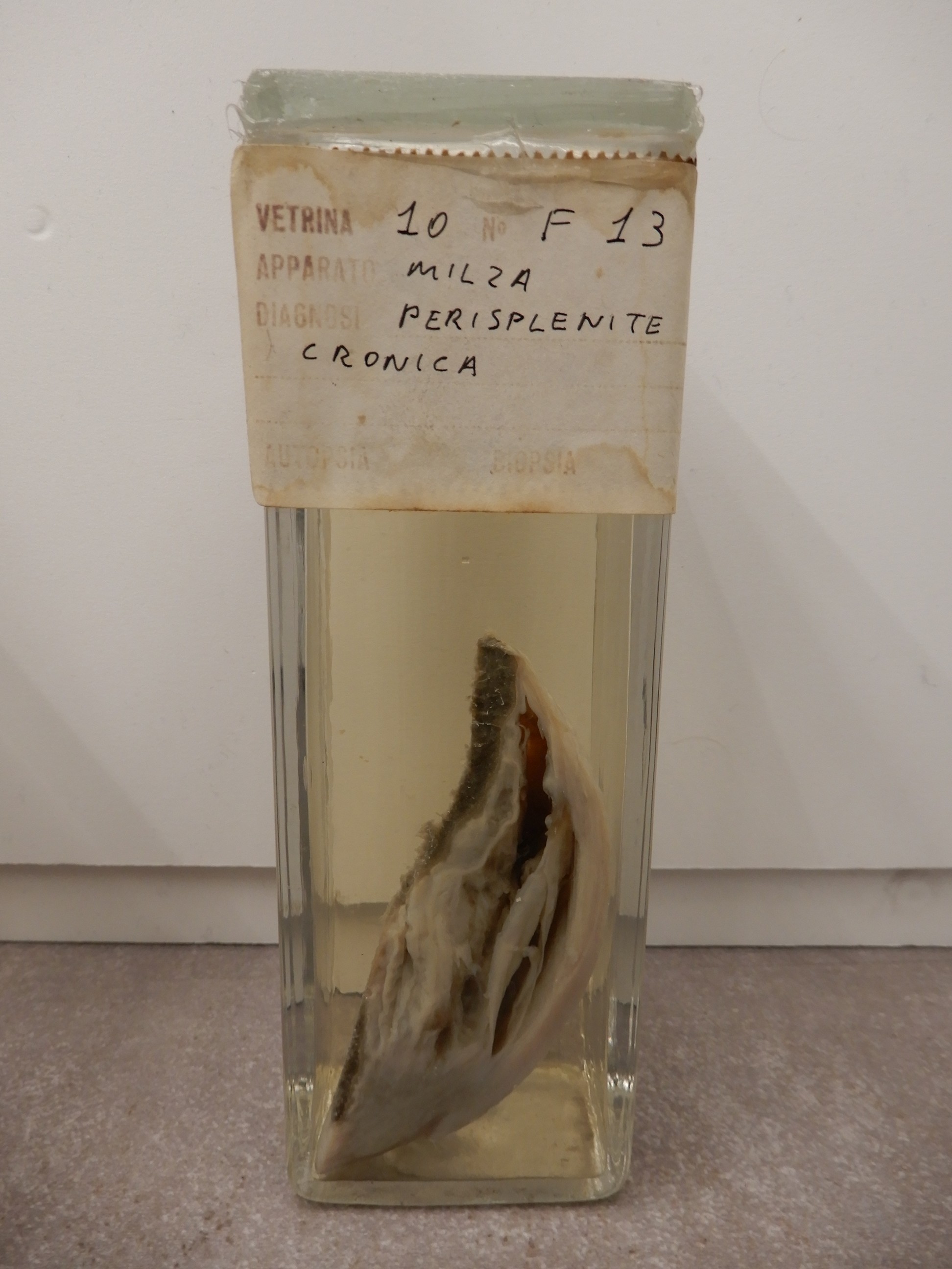 singolo reperto antropologico, preparato anatomico (morfologia alterata per patologia) (XIX-XX)