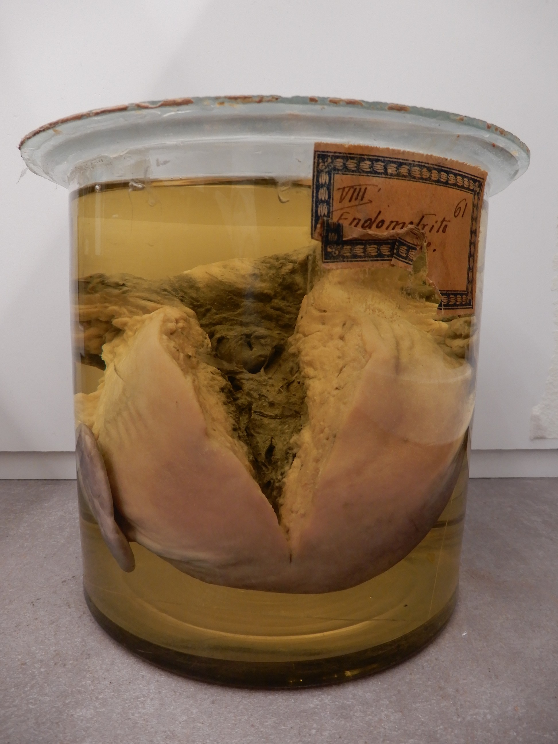 singolo reperto antropologico, preparato anatomico (morfologia alterata per patologia) (XIX-XX)