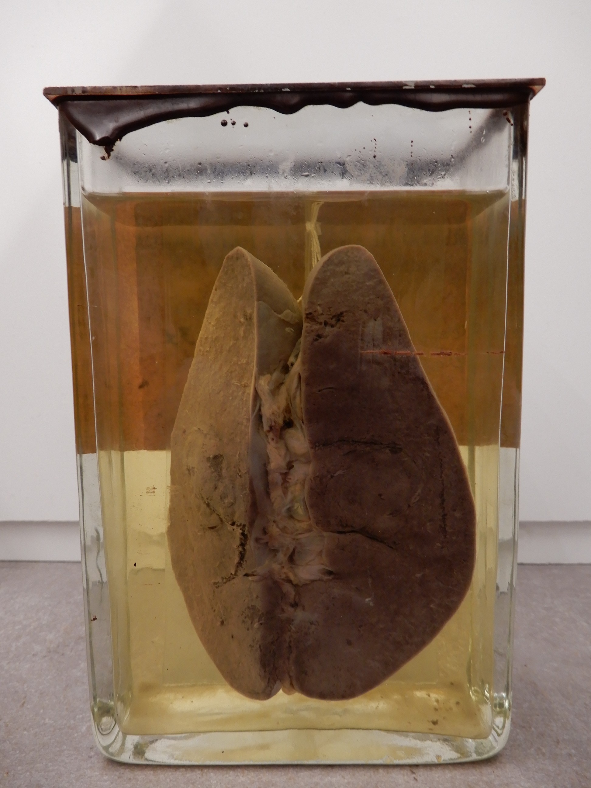 singolo reperto antropologico, preparato anatomico (morfologia alterata per patologia) (XIX-XX)