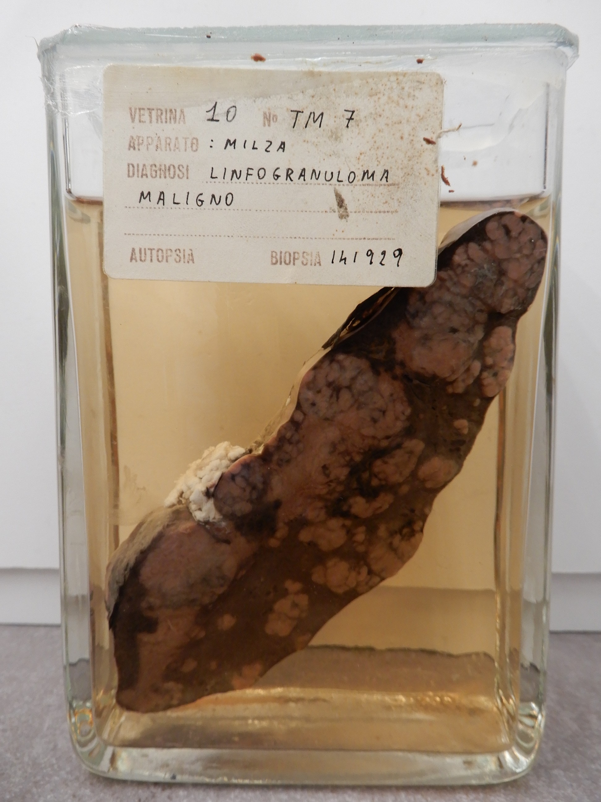 singolo reperto antropologico, preparato anatomico (morfologia alterata per patologia) (XIX-XX)