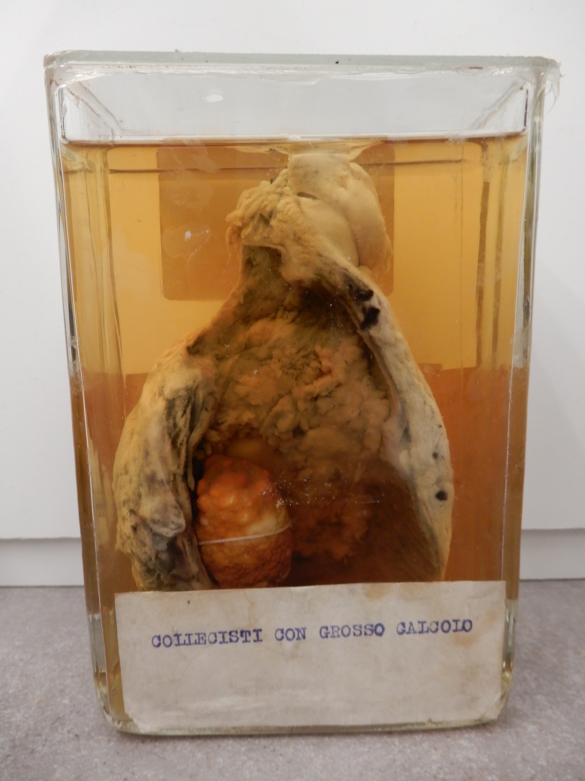 singolo reperto antropologico, preparato anatomico (morfologia alterata per patologia) (XIX-XX)