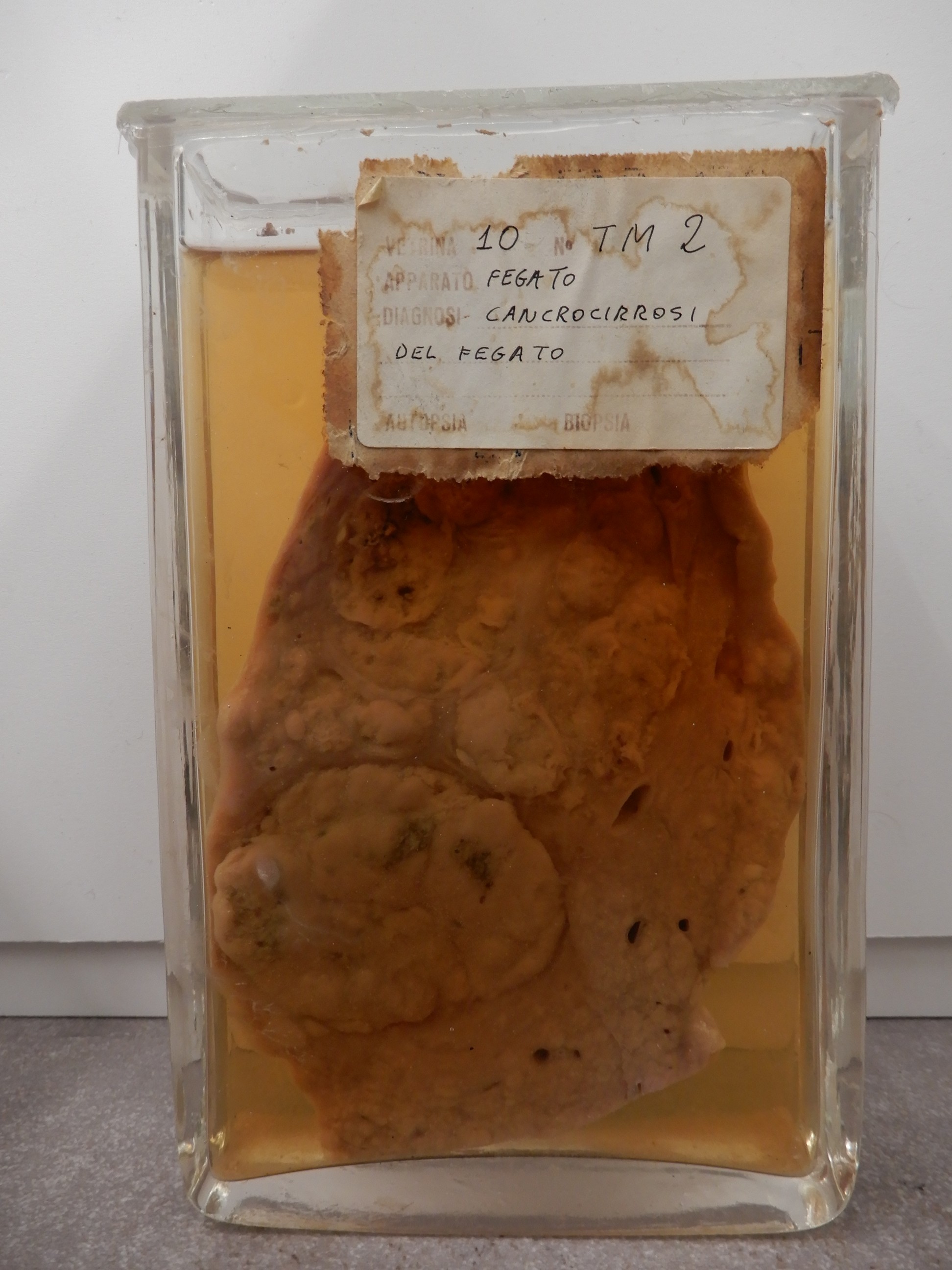 singolo reperto antropologico, preparato anatomico (morfologia alterata per patologia) (XIX-XX)