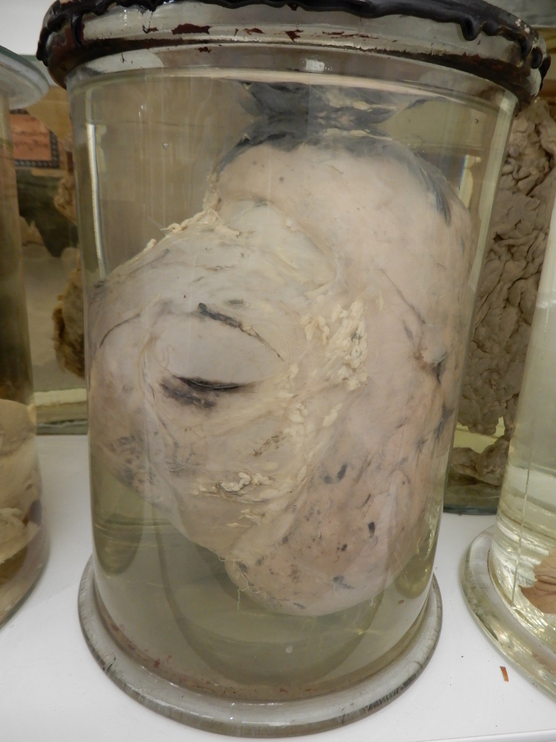 singolo reperto antropologico, preparato anatomico (morfologia alterata per patologia) (XIX-XX)