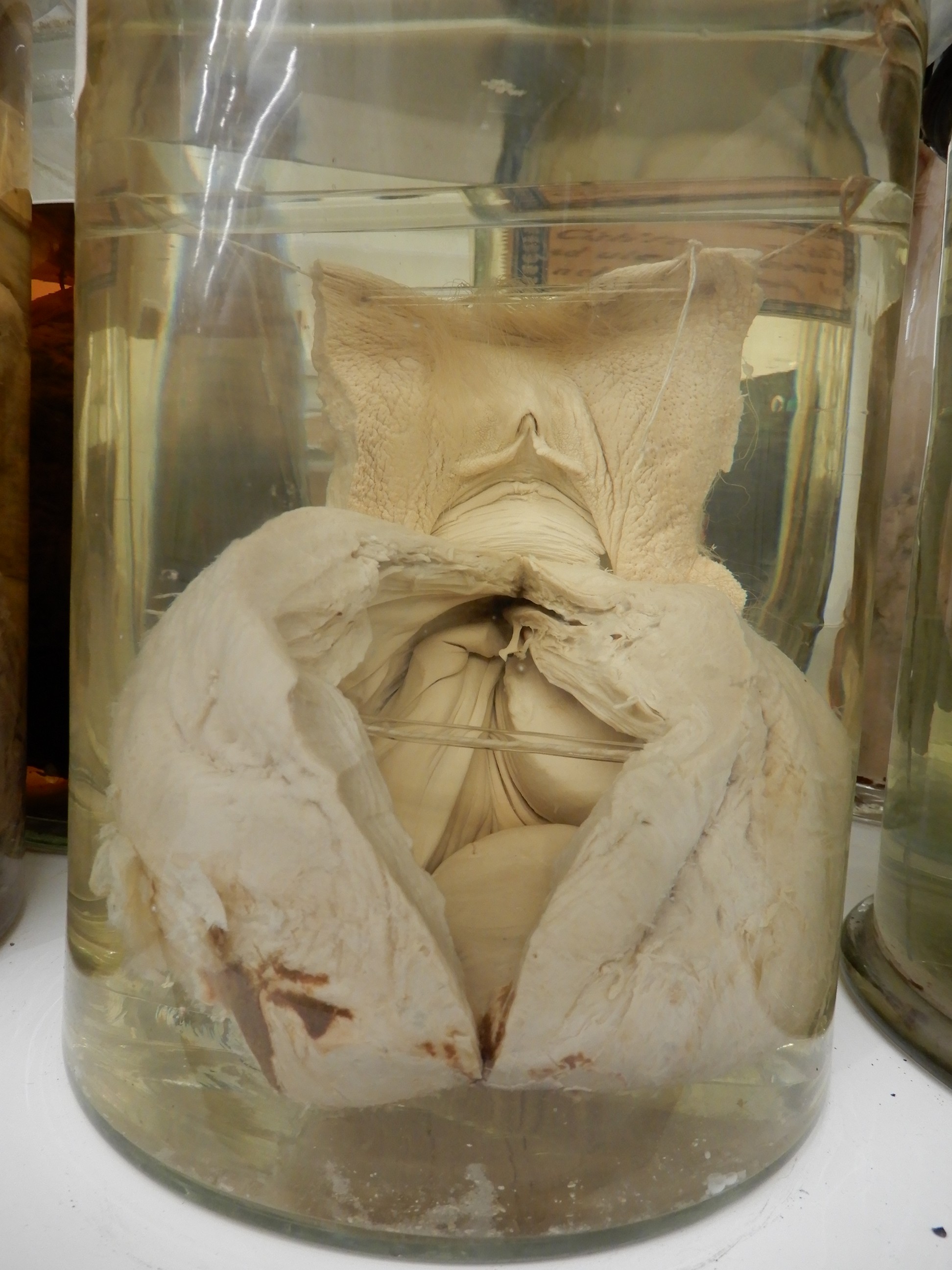 singolo reperto antropologico, preparato anatomico (morfologia alterata per patologia) (XIX-XX)